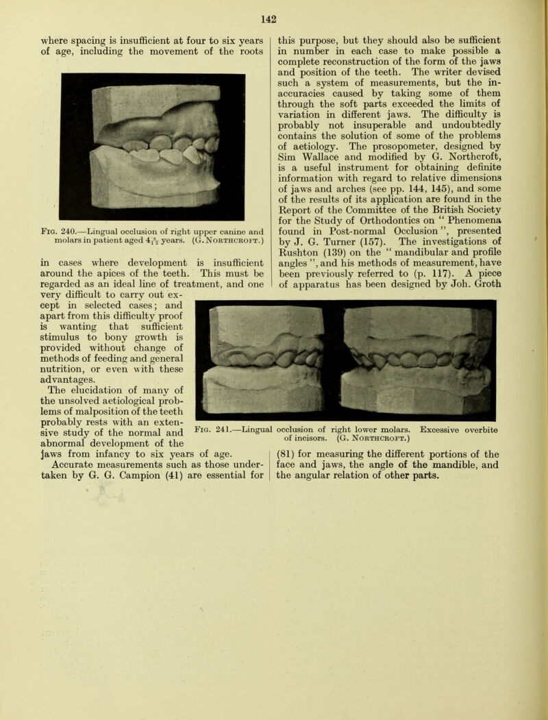 where spacing is insufficient at four to six years of age, including the movement of the roots Fig. 240.—Lingual occlusion of right upper canine and molars in patient aged 4,\ years. (G.Northcroft.) in cases where development is insufficient around the apices of the teeth. This must be regarded as an ideal line of treatment, and one very difficult to carry out ex- cept in selected cases; and apart from this difficulty proof is wanting that sufficient stimulus to bony growth is provided without change of methods of feeding and general nutrition, or even with these advantages. The elucidation of many of the unsolved aetiological prob- lems of malposition of the teeth probably rests with an exten- sive study of the normal and abnormal development of the jaws from infancy to six years of age. Accurate measurements such as those under- taken by G. G. Campion (41) are essential for this purpose, but they should also be sufficient in number in each case to make possible a complete reconstruction of the form of the jaws and position of the teeth. The writer devised such a system of measurements, but the in- accuracies caused by taking some of them through the soft parts exceeded the limits of variation in different jaws. The difficulty is probably not insuperable and undoubtedly contains the solution of some of the problems of aetiology. The prosopometer, designed by Sim Wallace and modified by G. Northcroft, is a useful instrument for obtaining definite information with regard to relative dimensions of jaws and arches (see pp. 144, 145), and some of the results of its application are found in the Report of the Committee of the British Society for the Study of Orthodontics on  Phenomena found in Post-normal Occlusion, presented by J. G. Turner (157). The investigations of Rushton (139) on the  mandibular and profile angles ,and his methods of measurement, have been previously referred to (p. 117). A piece of apparatus has been designed by Joh. Groth Fig. 241.—Lingual occlusion of right lower molars. Excessive overbite of incisors. (G. North croft.) (81) for measuring the different portions of the face and jaws, the angle of the mandible, and the angular relation of other parts.