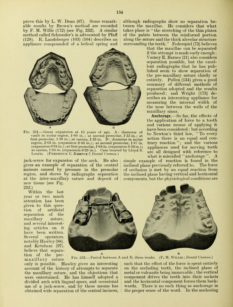 prove this by L. W. Dean (67). Some remark- able results by Brown's method are recorded by F. M. Willis (172) (see Fig. 252). A similar method called Schroeder's is advocated by Pfaff (128). R. Landsberger (103) (104) describes an appliance compounded of a helical spring and Fig. 251.—Great expansion at 13 years of age. A : diameter of vault in molar region, 1-60 in.; at second premolar, 1-33 in.; at first premolar, l-38 in.; at canine, l-25 in. B : diameter in molar region, 2-05 in. (expansion 0-45 in.); at second premolar, 187 in. (expansion 0'54in.); at first premolar, 1-68 in. (expansion 0-30 in.); at canine, 1*54 in. (expansion 0-29 in.). Case treated by Lloyd S. Lourie. (Frederick C. Kemple :] Dental Cosmos.) jack-screw for expansion of the arch. He also gives an example of separation of the central incisors caused by pressure in the premolar region, and shows by radiographs separation at the inter-maxillary suture and deposit of new tissue (see Fig. 253.) Within the last year or two much attention has been given to this ques- tion of artificial separation of the maxillary suture, and several interest- ing articles on it have been written. Several operators, notably Hawley (88), and Ketcham (97), believe that separa- tion of the pre- maxillary suture only is possible. Hawley gives an interesting account of the history of attempts to separate the maxillary suture, and the objections that were entertained. He has himself adopted a divided arch with lingual spurs, and occasional use of a jack-screw, and by these means has obtained wide separation of the central incisors, although radiographs show no separation be- tween the maxillae. He considers that what takes place is  the stretching of the thin plates of the palate between the reinforced portion along the suture and the thick alveolar structure surrounding the teeth. Federspiel (73) believes that the maxillae can be separated if the attempt is made early enough; Varney E. Barnes (21) also considers separation possible, but the excel- lent radiographs that he has pub- lished seem to show separation of the pre-maxillary suture chiefly or entirely. Pullen (134) gives a good summary of different methods of separation adopted and the results produced; and Wright (173) de- scribes an interesting appliance for measuring the internal width of the nose between the walls of the maxillary sinus. Anchorage.—So far, the effects of the application of force to a tooth and various means of applying it have been considered ; but according to Newton's third law,  To every action there is an equal and con- trary reaction  ; and the various appliances used for moving teeth are all designed with reference to what is miscalled  anchorage . A simple example of reaction is found hi the inclined plane previously referred to. The force of occlusion is met by an equal reaction from the inclined plane having vertical and horizontal components, but the physiological conditions are Fig. 252.—Period between A and B, three weeks. (F. M. Willis : Dental Cosmos.) such that the effect of the force is spent entirely on the occluding teeth, the inclined plane of metal or vulcanite being immovable ; the vertical component drives the teeth into their sockets and the horizontal component forces them back- wards. There is no such thing as anchorage in the proper sense of the word. In the anchoring