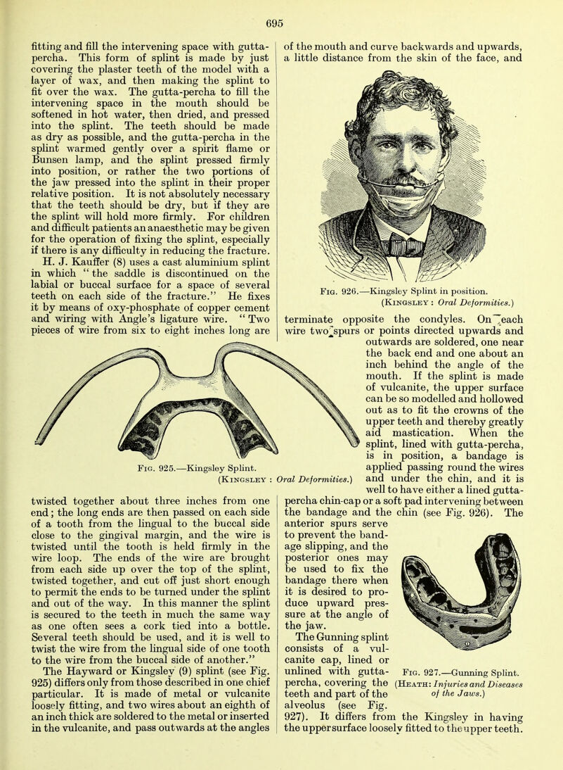 fitting and fill the intervening space with gutta- percha. This form of splint is made by just covering the plaster teeth of the model with a layer of wax, and then making the splint to fit over the wax. The gutta-percha to fill the intervening space in the mouth should be softened in hot water, then dried, and pressed into the splint. The teeth should be made as dry as possible, and the gutta-percha in the splint warmed gently over a spirit flame or Bunsen lamp, and the splint pressed firmly into position, or rather the two portions of the jaw pressed into the splint in their proper relative position. It is not absolutely necessary that the teeth should be dry, but if they are the splint will hold more firmly. For children and difficult patients an anaesthetic may be given for the operation of fixing the splint, especially if there is any difficulty in reducing the fracture. H. J. Kauffer (8) uses a cast aluminium splint in which  the saddle is discontinued on the labial or buccal surface for a space of several teeth on each side of the fracture. He fixes it by means of oxy-phosphate of copper cement and wiring with Angle's ligature wire.  Two pieces of wire from six to eight inches long are of the mouth and curve backwards and upwards, a little distance from the skin of the face, and Fig. 925.—Kingsley Splint. (KiNGSLEY : twisted together about three inches from one end; the long ends are then passed on each side of a tooth from the lingual to the buccal side close to the gingival margin, and the wire is twisted until the tooth is held firmly in the wire loop. The ends of the wire are brought from each side up over the top of the splint, twisted together, and cut off just short enough to permit the ends to be turned under the splint and out of the way. In this manner the splint is secured to the teeth in much the same way as one often sees a cork tied into a bottle. Several teeth should be used, and it is well to twist the wire from the lingual side of one tooth to the wire from the buccal side of another. The Hay ward or Kingsley (9) splint (see Fig. 925) differs only from those described in one chief particular. It is made of metal or vulcanite loosely fitting, and two wires about an eighth of an inch thick are soldered to the metal or inserted in the vulcanite, and pass outwards at the angles Oral Deformities.) Fig. 926.—Kingsley Splint in position. (Kingsley: Oral Deformities.) terminate opposite the condyles. On Teach wire two^spurs or points directed upwards and outwards are soldered, one near the back end and one about an inch behind the angle of the mouth. If the splint is made of vulcanite, the upper surface can be so modelled and hollowed out as to fit the crowns of the upper teeth and thereby greatly aid mastication. When the splint, lined with gutta-percha, is in position, a bandage is applied passing round the wires and under the chin, and it is well to have either a lined gutta- percha chin-cap or a soft pad intervening between the bandage and the chin (see Fig. 926). The anterior spurs serve to prevent the band- age slipping, and the posterior ones may be used to fix the bandage there when it is desired to pro- duce upward pres- sure at the angle of the jaw. The Gunning splint consists of a vul- canite cap, lined or unlined with gutta- Fig. 927.—Gunning Splint, percha, covering the (Heath: Injuries and Diseases teeth and part of the of the Jaws.) alveolus (see Fig. 927). It differs from the Kingsley in having the uppersurface loosely fitted to the upper teeth.