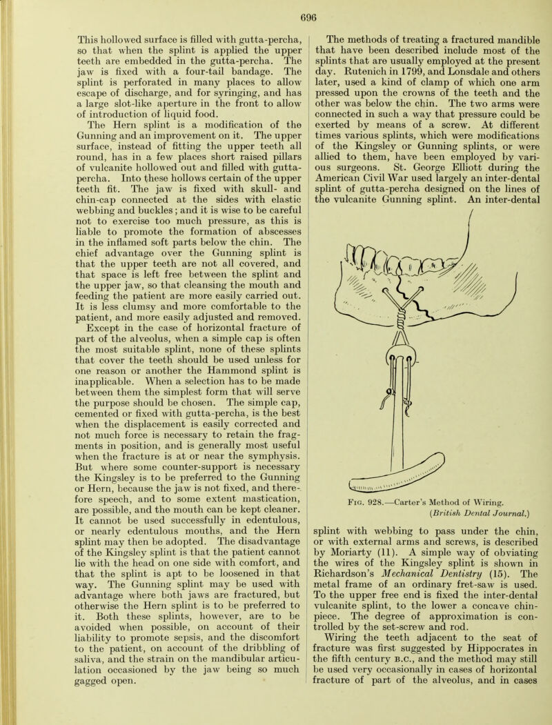 This hollowed surface is filled with gutta-percha, so that when the splint is applied the upper teeth are embedded in the gutta-percha. The jaw is fixed with a four-tail bandage. The splint is perforated in many places to allow escape of discharge, and for syringing, and has a large slot-like aperture in the front to allow of introduction of liquid food. The Hern splint is a modification of the Gunning and an improvement on it. The upper surface, instead of fitting the upper teeth all round, has in a few places short raised pillars of vulcanite hollowed out and filled with gutta- percha. Into these hollows certain of the upper teeth fit. The jaw is fixed with skull- and chin-cap connected at the sides with elastic webbing and buckles; and it is wise to be careful not to exercise too much pressure, as this is liable to promote the formation of abscesses in the inflamed soft parts below the chin. The chief advantage over the Gunning splint is that the upper teeth are not all covered, and that space is left free between the splint and the upper jaw, so that cleansing the mouth and feeding the patient are more easily carried out. It is less clumsy and more comfortable to the patient, and more easily adjusted and removed. Except in the case of horizontal fracture of part of the alveolus, when a simple cap is often the most suitable splint, none of these splints that cover the teeth should be used unless for one reason or another the Hammond splint is inapplicable. When a selection has to be made between them the simplest form that will serve the purpose should be chosen. The simple cap, cemented or fixed with gutta-percha, is the best when the displacement is easily corrected and not much force is necessary to retain the frag- ments in position, and is generally most useful when the fracture is at or near the symphysis. But where some counter-support is necessary the Kingsley is to be preferred to the Gunning or Hern, because the jaw is not fixed, and there- fore speech, and to some extent mastication, are possible, and the mouth can be kept cleaner. It cannot be used successfully in edentulous, or nearly edentulous mouths, and the Hern splint may then be adopted. The disadvantage of the Kingsley splint is that the patient cannot lie with the head on one side with comfort, and that the splint is apt to be loosened in that way. The Gunning splint may be used with advantage where both jaws are fractured, but otherwise the Hern splint is to be preferred to it. Both these splints, however, are to be avoided when possible, on account of their liability to promote sepsis, and the discomfort to the patient, on account of the dribbling of saliva, and the strain on the mandibular articu- lation occasioned by the jaw being so much gagged open. The methods of treating a fractured mandible that have been described include most of the splints that are usually employed at the present day. Rutenich in 1799, and Lonsdale and others later, used a kind of clamp of which one arm pressed upon the crowns of the teeth and the other was below the chin. The two arms were connected in such a way that pressure could be exerted by means of a screw. At different times various splints, which were modifications of the Kingsley or Gunning splints, or were allied to them, have been employed by vari- ous surgeons. St. George Elliott during the American Civil War used largely an inter-dental splint of gutta-percha designed on the lines of the vulcanite Gunning splint. An inter-dental Fig. 928.—Carter's Method of Wiring. (British Dental Journal.) splint with webbing to pass under the chin, or with external arms and screws, is described by Moriarty (11). A simple way of obviating the wires of the Kingsley splint is shown in Richardson's Mechanical Dentistry (15). The metal frame of an ordinary fret-saw is used. To the upper free end is fixed the inter-dental vulcanite splint, to the lower a concave chin- piece. The degree of approximation is con- trolled by the set-screw and rod. Wiring the teeth adjacent to the seat of fracture was first suggested by Hippocrates in the fifth century B.C., and the method may still be used very occasionally in cases of horizontal fracture of part of the alveolus, and in cases