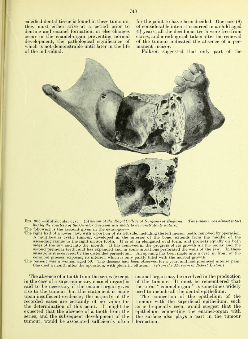 calcified dental tissue is found in these tumours, they must either arise at a period prior to dentine and enamel formation, or else changes occur in the enamel-organ preventing normal development, the pathological significance of which is not demonstrable until later in the life of the individual. for the point to have been decided. One case (8) of considerable interest occurred in a child aged 4i years; all the deciduous teeth were free from caries, and a radiograph taken after the removal of the tumour indicated the absence of a per- manent incisor. Falkson suggested that only part of the Fig. 963.—Multilocular cyst. (Museum of the Royal College of Surgeons of England. The tumour was almost intact but by the courtesy of the Curator a section was made to demonstrate its nature.) The following is the account given in the catalogue—- The right half of a lower jaw, with a portion of its left side, including the left incisor teeth, removed by operation. A multilocular cystic tumour, developed in the interior of the bone, extends from the middle of the ascending ramus to the right incisor tooth. It is of an elongated oval form, and projects equally on both sides of the jaw and into the mouth. It has removed in the progress of its growth all the molar and the second premolar teeth, and has expanded and in some situations perforated the walls of the jaw. In these situations it is covered by the distended periosteum. An opening has been made into a cyst, in front of the coronoid process, exposing its interior, which is only partly filled with the morbid growth. The patient was a woman aged 50. The disease had been observed for a year, and had produced intense pain. She died a month after the operation, with pleuritic effusion. (From the Museum of Robert Liston.) The absence of a tooth from the series (except in the case of a supernumerary enamel-organ) is said to be necessary if the enamel-organ gives rise to the tumour, but this statement is made upon insufficient evidence ; the majority of the recorded cases are certainly of no value for the determination of this point. It might be expected that the absence of a tooth from the series, and the subsequent development of the tumour, would be associated sufficiently often enamel-organ may be involved in the production of the tumour. It must be remembered that the term  enamel-organ  is sometimes widely used to include all the dental epithelium. The connection of the epithelium of the tumour with the superficial epithelium, such as is frequently seen, would suggest that the epithelium connecting the enamel-organ with the surface also plays a part in the tumour formation.