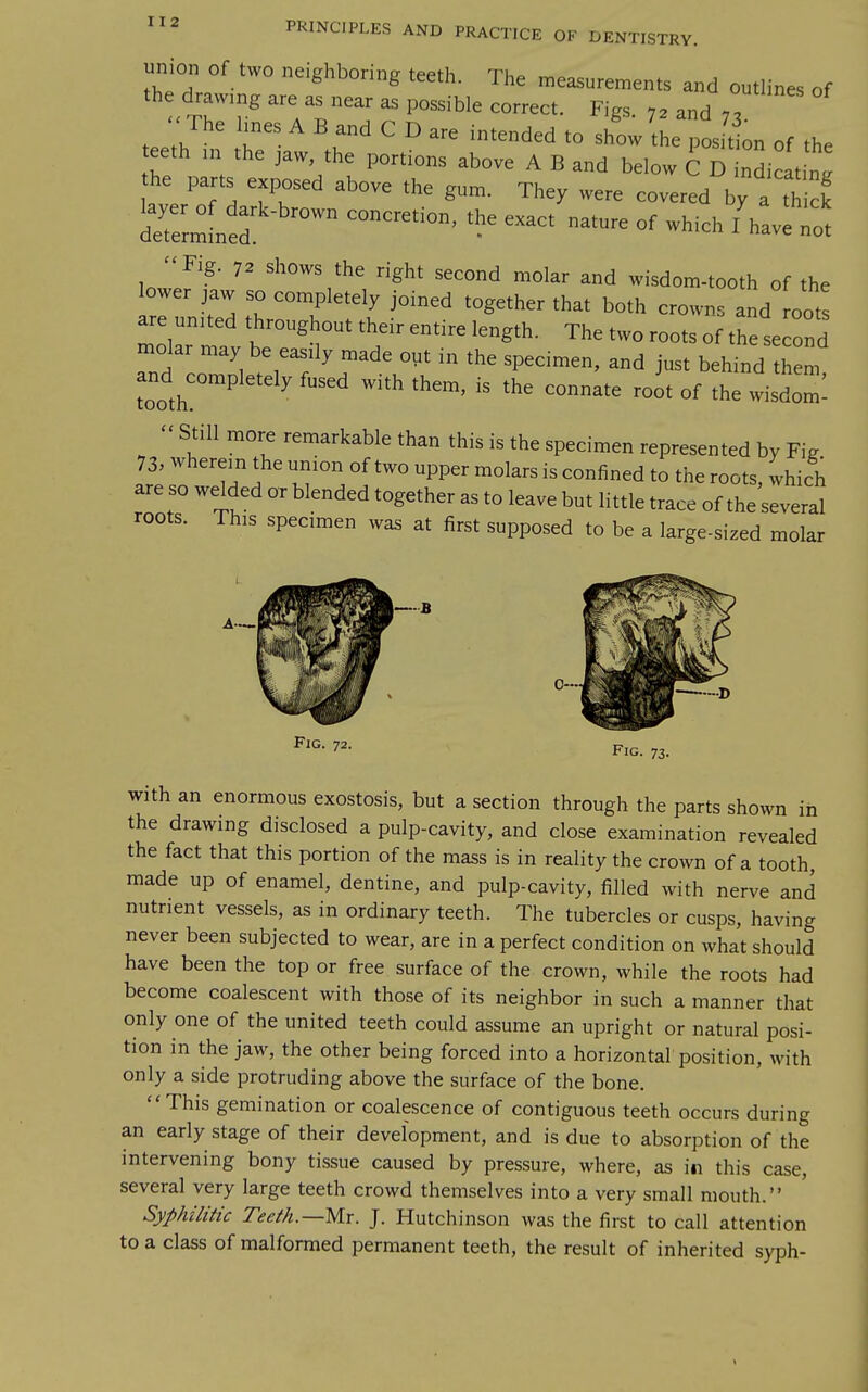 union Of two neighboring teeth. The measurements and outlines of the drawing are as near as possible correct. Figs. ,2 and 73. teeth in the ^  ''^'^^^ '° P«'' » of the teeth m the jaw, the portions above A B and below C D indicating he parts exposed above the gum. They were covered by a h f dTe^Led ° '''^ °f -■'-^ ' -t Fig. 7. shows the right second molar and wisdom-tooth of the lower ,aw so completely Joined together that both crowns and oot are united throughout their entire length. The two roots of the second molar may be easily made otit in the specimen, and just behind then, and^completely fused with them, is the connate root of the wisdom:  Still more remarkable than this is the specimen represented by Fig 73. wherein the union of two upper molars is confined to the roots, which are so welded or blended together as to leave but little trace of the several roots. This specimen was at first supposed to be a large-sized molar A— Fig. 73. with an enormous exostosis, but a section through the parts shown in the drawing disclosed a pulp-cavity, and close examination revealed the fact that this portion of the mass is in reality the crown of a tooth, made up of enamel, dentine, and pulp-cavity, filled with nerve and nutrient vessels, as in ordinary teeth. The tubercles or cusps, having never been subjected to wear, are in a perfect condition on what should have been the top or free surface of the crown, while the roots had become coalescent with those of its neighbor in such a manner that only one of the united teeth could assume an upright or natural posi- tion in the jaw, the other being forced into a horizontal position, with only a side protruding above the surface of the bone. This gemination or coalescence of contiguous teeth occurs during an early stage of their development, and is due to absorption of the intervening bony tissue caused by pressure, where, as in this case, several very large teeth crowd themselves into a very small mouth. Syphilitic Teeth.—Mr. J. Hutchinson was the first to call attention to a class of malformed permanent teeth, the result of inherited syph-