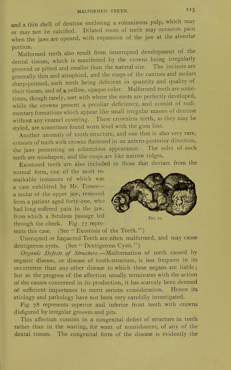 and a thin shell of dentine enclosing a voluminous pulp, which may or may not be calcified. Dilated roots of teeth may occasion pam when the jaws are opened, with expansion of the jaw at the alveolar portion. Malformed teeth also result from interrupted development of the dental tissues, which is manifested by the crowns being irregularly grooved or pitted and smaller than the natural size. The incisors are generally thin and atrophied, and the cusps of the canines and molars sharp-pointed, such teeth being deficient in quantity and quality of their tissues, and of a yellow, opaque color. Malformed teeth are some- times, though rarely, met with where the roots are perfectly developed, while the crowns present a peculiar deficiency, and consist of rudi- mentary formations which appear like small irregular masses of dentine without any. enamel covering. These crownless teeth, as they may be styled, are sometimes found worn level with the gum line. Another anomaly of tooth-structure, and one that is also very rare, consists of teeth with crowns flattened in an antero-posterior direction, the jaws presenting an edentulous appearance. The sulci of such teeth are misshapen, and the cusps are like narrow ridges. Exostosed teeth are also included in those that deviate from the normal form, one of the most re- markable instances of which was a case exhibited by Mr. Tomes— a molar of the upper jaw, removed from a patient aged forty-one, who had long suffered pain in the jaw, from which a fistulous passage led through the cheek. Fig. 77 repre- sents this case. (See  Exostosis of the Teeth.) Unerupted or Impacted Teeth are often malformed, and may cause dentigerous cysts. (See  Dentigerous Cysts.) Organic Defects of Structure.—Malformation of teeth caused by organic disease, or disease of tooth-structure, is less frequent in its occurrence than any other disease to which these organs are liable; but as the progress of the affection usually terminates with the action of the causes concerned in its production, it has scarcely been deemed of sufficient importance to merit serious consideration. Hence its etiology and pathology have not been very carefully investigated. Fig. 78 represents superior and inferior front teeth with crowns disfigured by irregular grooves and pits. This affection consists in a congenital defect of structure in teeth rather than in the wasting, for want of nourishment, of any of the dental tissues. The congenital form of the disease is evidently the