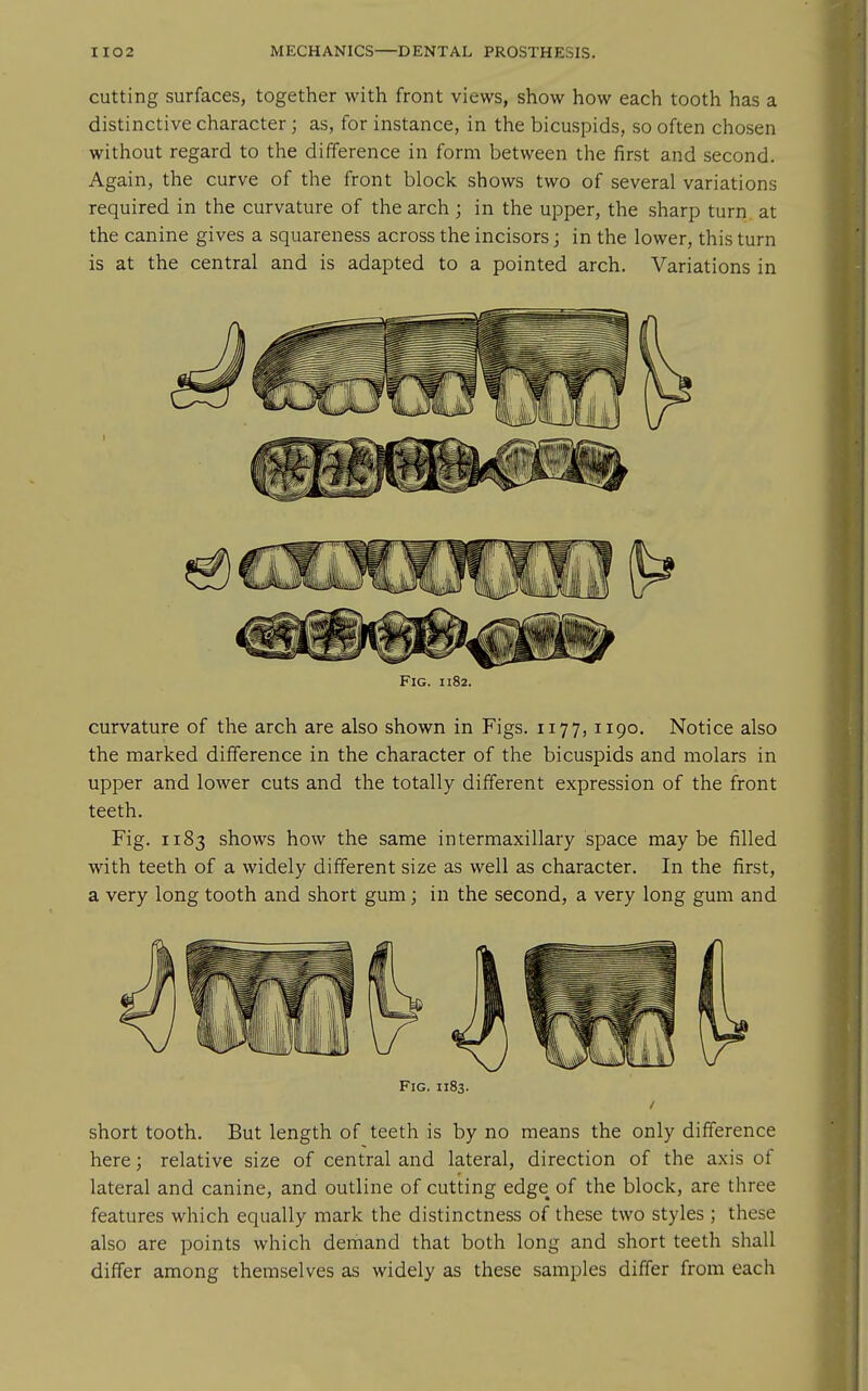 cutting surfaces, together with front views, show how each tooth has a distinctive character; as, for instance, in the bicuspids, so often chosen without regard to the difference in form between the first and second. Again, the curve of the front block shows two of several variations required in the curvature of the arch ; in the upper, the sharp turn at the canine gives a squareness across the incisors; in the lower, this turn is at the central and is adapted to a pointed arch. Variations in Fig. 1182. curvature of the arch are also shown in Figs. 1177, 1190. Notice also the marked difference in the character of the bicuspids and molars in upper and lower cuts and the totally different expression of the front teeth. Fig. 1183 shows how the same intermaxillary space maybe filled with teeth of a widely different size as well as character. In the first, a very long tooth and short gum; in the second, a very long gum and Fig. 1183. short tooth. But length of teeth is by no means the only difference here; relative size of central and lateral, direction of the axis of lateral and canine, and outline of cutting edge of the block, are three features which equally mark the distinctness of these two styles ; these also are points which demand that both long and short teeth shall differ among themselves as widely as these samples differ from each