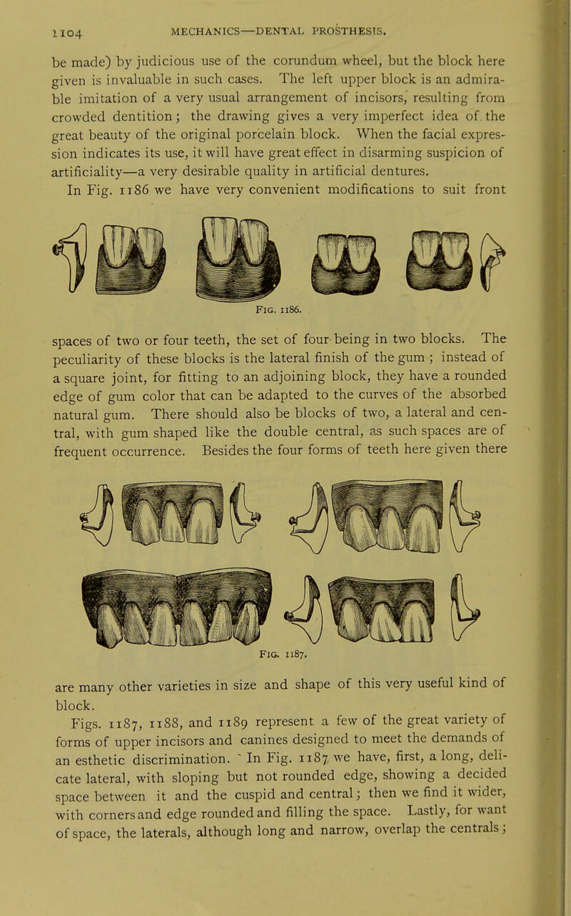 be made) by judicious use of the corundum wheel, but the block here given is invaluable in such cases. The left upper block is an admira- ble imitation of a very usual arrangement of incisors, resulting from crowded dentition; the drawing gives a very imperfect idea of. the great beauty of the original porcelain block. When the facial expres- sion indicates its use, it will have great effect in disarming suspicion of artificiality—a very desirable quality in artificial dentures. In Fig. 1186 we have very convenient modifications to suit front Fig. ii86. spaces of two or four teeth, the set of four being in two blocks. The peculiarity of these blocks is the lateral finish of the gum ; instead of a square joint, for fitting to an adjoining block, they have a rounded edge of gum color that can be adapted to the curves of the absorbed natural gum. There should also be blocks of two, a lateral and cen- tral, with gum shaped like the double central, as such spaces are of frequent occurrence. Besides the four forms of teeth here given there Fig. 1187. are many other varieties in size and shape of this very useful kind of block. Figs. 1187, 1188, and 1189 represent a few of the great variety of forms of upper incisors and canines designed to meet the demands of an esthetic discrimination. ~ In Fig. 1187 we have, first, a long, deli- cate lateral, with sloping but not rounded edge, showing a decided space between it and the cuspid and central; then we find it wider, with corners and edge rounded and filling the space. Lastly, for want of space, the laterals, although long and narrow, overlap the centrals;