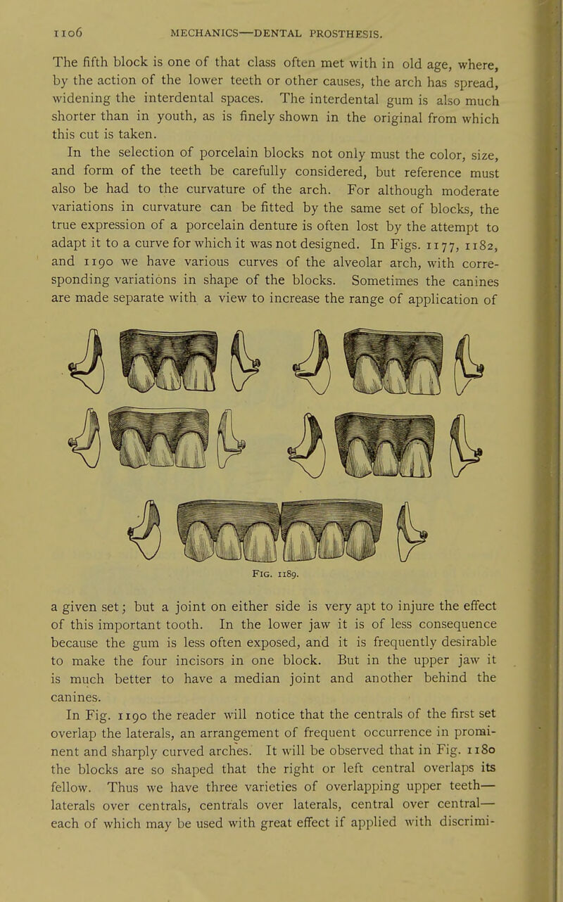 The fifth block is one of that class often met with in old age, where, by the action of the lower teeth or other causes, the arch has spread, widening the interdental spaces. The interdental gum is also much shorter than in youth, as is finely shown in the original from which this cut is taken. In the selection of porcelain blocks not only must the color, size, and form of the teeth be carefully considered, but reference must also be had to the curvature of the arch. For although moderate variations in curvature can be fitted by the same set of blocks, the true expression of a porcelain denture is often lost by the attempt to adapt it to a curve for which it was not designed. In Figs. 1177, 1182, and 1190 we have various curves of the alveolar arch, with corre- sponding variations in shape of the blocks. Sometimes the canines are made separate with a view to increase the range of application of Fig. 1189. a given set; but a joint on either side is very apt to injure the effect of this important tooth. In the lower jaw it is of less consequence because the gum is less often exposed, and it is frequently desirable to make the four incisors in one block. But in the upper jaw it is much better to have a median joint and another behind the canines. In Fig. 1190 the reader will notice that the centrals of the first set overlap the laterals, an arrangement of frequent occurrence in promi- nent and sharply curved arches. It will be observed that in Fig. 1180 the blocks are so shaped that the right or left central overlaps its fellow. Thus we have three varieties of overlapping upper teeth— laterals over centrals, centrals over laterals, central over central— each of which may be used with great effect if applied with discrimi-