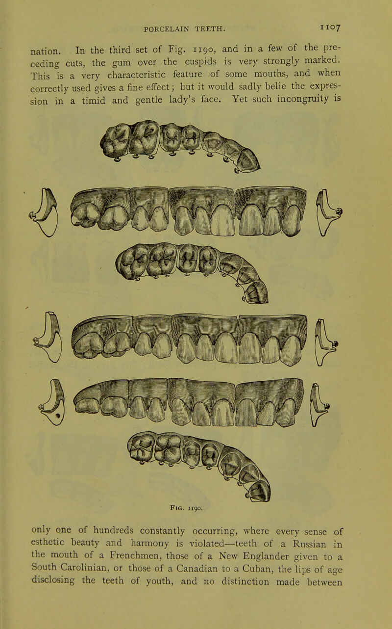 nation. In the third set of Fig. 1190, and in a few of the pre- ceding cuts, the gum over the cuspids is very strongly marked. This is a very characteristic feature of some mouths, and when correctly used gives a fine effect; but it would sadly belie the expres- sion in a timid and gentle lady's face. Yet such incongruity is Fig. 1190. only one of hundreds constantly occurring, where every sense of esthetic beauty and harmony is violated—teeth of a Russian in the mouth of a Frenchmen, those of a New Englander given to a South Carolinian, or those of a Canadian to a Cuban, the lips of age disclosing the teeth of youth, and no distinction made between