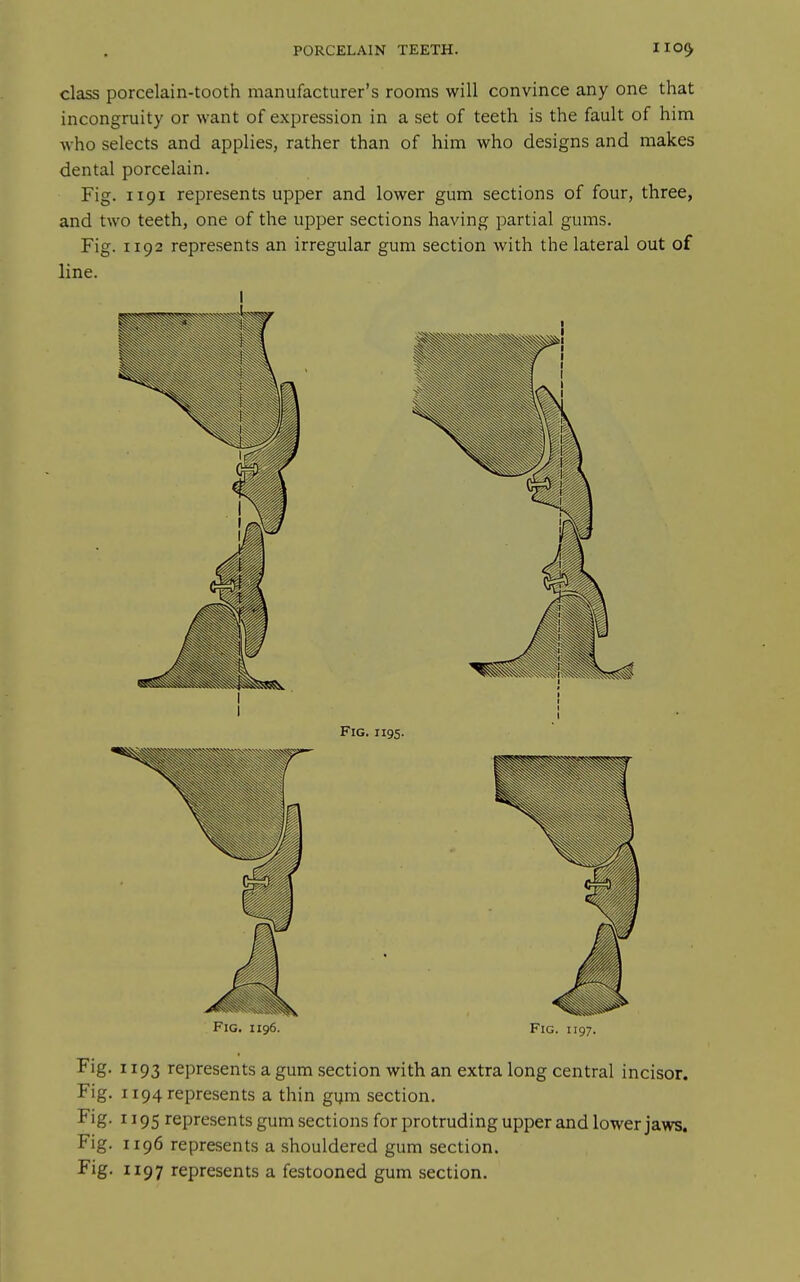 class porcelain-tooth manufacturer's rooms will convince any one that incongruity or want of expression in a set of teeth is the fault of him who selects and applies, rather than of him who designs and makes dental porcelain. Fig. 1191 represents upper and lower gum sections of four, three, and two teeth, one of the upper sections having partial gums. Fig. 1192 represents an irregular gum section with the lateral out of line. I Fig. 1196. Fig. 1197. ^ig- 1193 represents a gum section with an extra long central incisor. Fig. 1194 represents a thin gum section. ^^S- 1195 represents gum sections for protruding upper and lower jaws. Fig. 1196 represents a shouldered gum section. Fig, 1197 represents a festooned gum section.