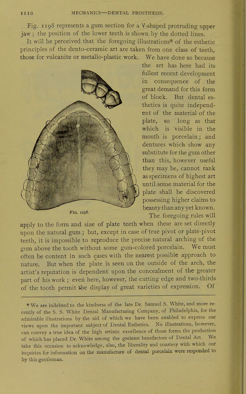 Fig. 1198 represents a gum section for a V-shaped protruding upper jaw; the position of the lower teeth is shown by the dotted lines. It will be perceived that the foregoing illustrations* of the esthetic principles of the dento-ceramic art are taken from one class of teeth, those for vulcanite or metallo-plastic work. We have done so because the art has here had its fullest recent development in consequence of the great demand for this form of block. But dental es- thetics is quite independ- ent of the material of the plate, so long as that which is visible in the mouth is porcelain; and dentures which show any substitute for the gum other than this, however useful they may be, cannot rank as specimens of highest art until,some material for the plate shall be discovered possessing higher claims to beauty than any yet known. The foregoing rules will apply to the form and size of plate teeth when these are set directly upon the natural gum ; but, except in case of true pivot or plate-pivot teeth, it is impossible to reproduce the precise natural arching of the gum above the tooth without some gum-colored porcelain. We must often be content in such cases with the nearest possible approach to nature. But when the plate is seen on the outside of the arch, the artist's reputation is dependent upon the concealment of the greater part of his work ; even here, however, the cutting edge and two-thirds of the tooth permit fehe display of great varieties of expression. Of *We are indebted to the kindness of the late Dr. Samuel S. White, and more re- cently of the S. S. White Dental Manufacturing Company, of Philadelphia, for the admirable illustrations by the aid of which we have been enabled to express our views upon the important subject x)f Dental Esthetics. No illustrations, however, can convey a true idea of the high artistic excellence of those forms the production of which has placed Dr. White among the greatest benefactors of Dental Art. We take this occasion to acknowledge, also, the liberality and courtesy with which our inquiries for information on the manufacture of dental porcelain were responded to by this gentleman.
