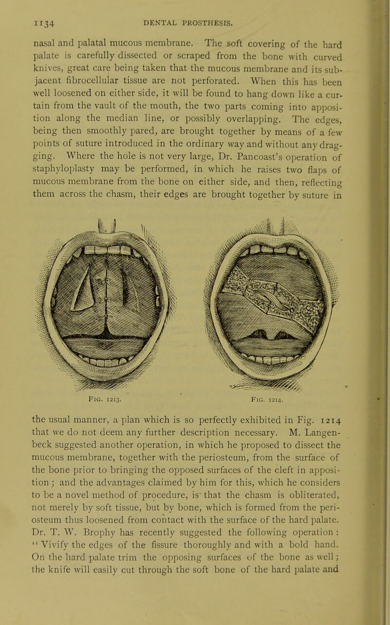 nasal and palatal mucous membrane. The soft covering of the hard palate is carefully dissected or scraped from the bone with curved knives, great care being taken that the mucous membrane and its sub- jacent fibrocellular tissue are not perforated. When this has been well loosened on either side, it will be found to hang down like a cur- tain from the vault of the mouth, the two parts coming into apposi- tion along the median line, or possibly overlapping. The edges, being then smoothly pared, are brought together by means of a few points of suture introduced in the ordinary way and without any drag- ging. Where the hole is not very large, Dr. Pancoast's operation of staphyloplasty may be performed, in which he raises two flaps of mucous membrane from the bone on either side, and then, reflecting them across the chasm, their edges are brought together by suture in Fig. 1213. Fig. 1214. the usual manner, a plan which is so perfectly exhibited in Fig. 1214 that we do not deem any further description necessary. M. Langen- beck suggested another operation, in which he proposed to dissect the mucous membrane, together with the periosteum, from the surface of the bone prior to bringing the opposed surfaces of the cleft in apposi- tion ; and the advantages claimed by him for this, which he considers to be a novel method of procedure, is' that the chasm is obliterated, not merely by soft tissue, but by bone, which is formed from the peri- osteum thus loosened from contact with the surface of the hard palate. Dr. T. W. Brophy has recently suggested the following operation :  Vivify the edges of the fissure thoroughly and with a bold hand. On the hard palate trim the opposing surfaces uf the bone as well; the knife will easily cut through the soft bone of the hard palate and