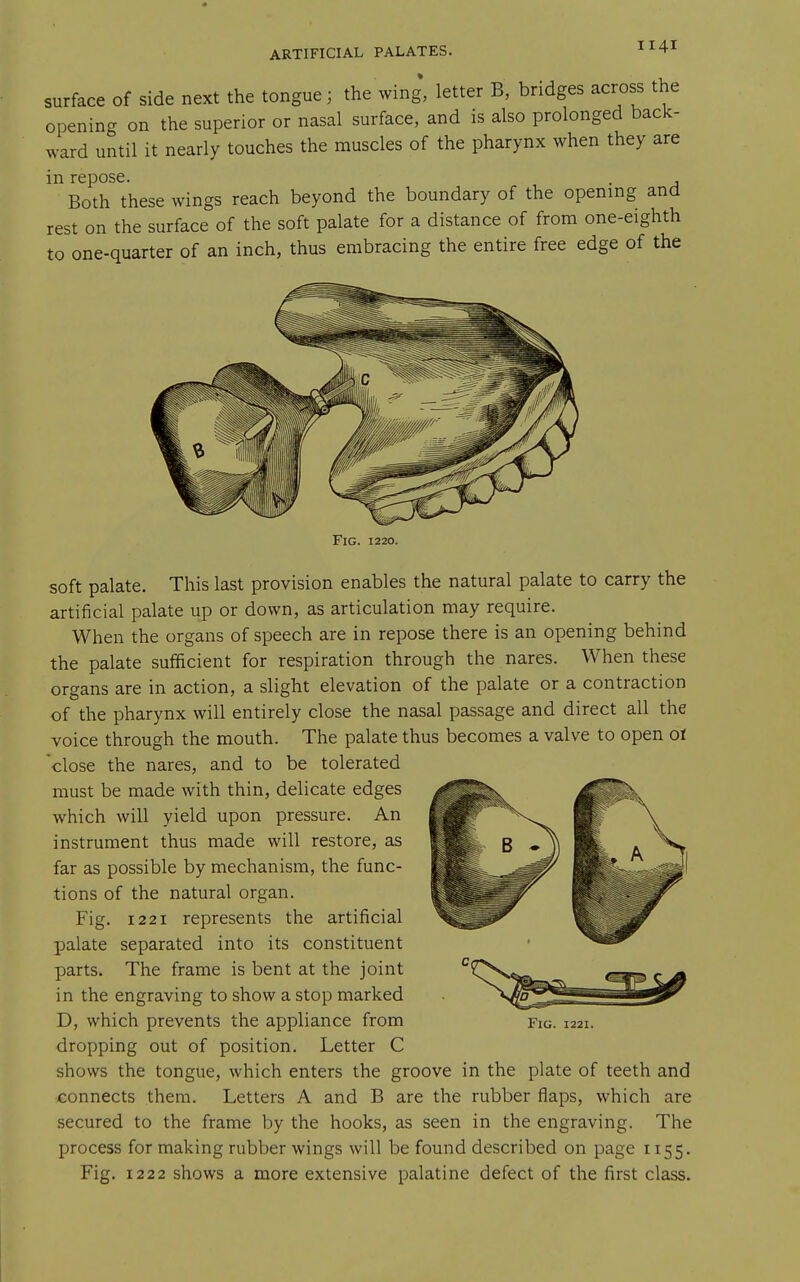 surface of side next the tongue; the wing, letter B, bridges across the opening on the superior or nasal surface, and is also prolonged back- ward until it nearly touches the muscles of the pharynx when they are in repose. . , Both these wings reach beyond the boundary of the opening and rest on the surface of the soft palate for a distance of from one-eighth to one-quarter of an inch, thus embracing the entire free edge of the Fig. 1220. soft palate. This last provision enables the natural palate to carry the artificial palate up or down, as articulation may require. When the organs of speech are in repose there is an opening behind the palate sufficient for respiration through the nares. When these organs are in action, a slight elevation of the palate or a contraction of the pharynx will entirely close the nasal passage and direct all the voice through the mouth. The palate thus becomes a valve to open ot close the nares, and to be tolerated must be made with thin, delicate edges which will yield upon pressure. An instrument thus made will restore, as far as possible by mechanism, the func- tions of the natural organ. Fig. 1221 represents the artificial palate separated into its constituent parts. The frame is bent at the joint in the engraving to show a stop marked D, which prevents the appliance from dropping out of position. Letter C shows the tongue, which enters the groove in the plate of teeth and connects them. Letters A and B are the rubber flaps, which are secured to the frame by the hooks, as seen in the engraving. The process for making rubber wings will be found described on page 1155. Fig. 1222 shows a more extensive palatine defect of the first class. Fig. 1221.