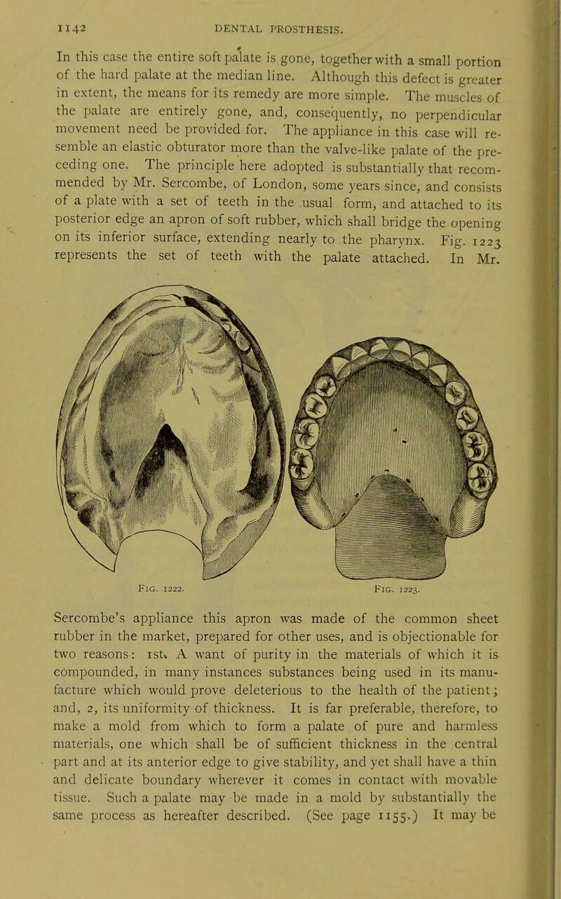 In this case the entire soft palate is gone, together with a small portion of the hard palate at the median line. Although this defect is greater in extent, the means for its remedy are more simple. The muscles of the palate are entirely gone, and, consequently, no perpendicular movement need be provided for. The appliance in this case will re- semble an elastic obturator more than the valve-like palate of the pre- ceding one. The principle here adopted is substantially that recom- mended by Mr. Sercombe, of London, some years since, and consists of a plate with a set of teeth in the usual form, and attached to its posterior edge an apron of soft rubber, which shall bridge the opening on its inferior surface, extending nearly to the pharynx. Fig. 1223 represents the set of teeth with the palate attached. In Mr. Fig. 1222. Fig. 1223. Sercombe's appliance this apron was made of the common sheet rubber in the market, prepared for other uses, and is objectionable for two reasons: istv A want of purity in the materials of which it is compounded, in many instances substances being used in its manu- facture which would prove deleterious to the health of the patient; and, 2, its uniformity of thickness. It is far preferable, therefore, to make a mold from which to form a palate of pure and harmless materials, one which shall be of sufficient thickness in the central part and at its anterior edge to give stability, and yet shall have a thin and delicate boundary wherever it comes in contact with movable tissue. Such a palate may be made in a mold by substantially the same process as hereafter described. (See page 1155.) It maybe
