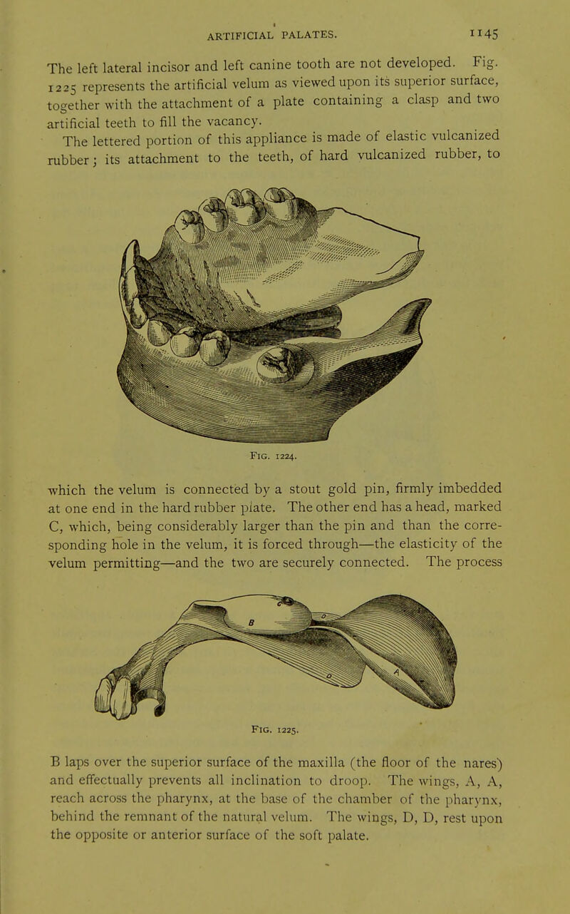 I ARTIFICIAL PALATES. The left lateral incisor and left canine tooth are not developed. Fig. 1225 represents the artificial velum as viewed upon its superior surface, toc^ether with the attachment of a plate containing a clasp and two artificial teeth to fill the vacancy. The lettered portion of this appliance is made of elastic vulcanized rubber; its attachment to the teeth, of hard vulcanized rubber, to Fig. 1224. which the velum is connected by a stout gold pin, firmly imbedded at one end in the hard rubber plate. The other end has a head, marked C, which, being considerably larger than the pin and than the corre- sponding hole in the velum, it is forced through—the elasticity of the velum permitting—and the two are securely connected. The process Fig. 1225. B laps over the superior surface of the maxilla (the floor of the nares) and effectually prevents all inclination to droop. The wings. A, A, reach across the pharynx, at the base of the chamber of the pharynx, behind the remnant of the natural velum. The wings, D, D, rest upon the opposite or anterior surface of the soft palate.