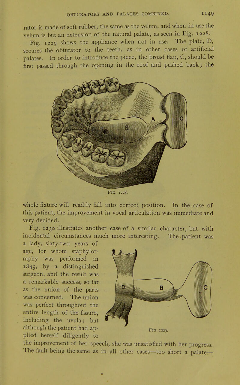 rator is made of soft rubber, the same as the velum, and when in use the velum is but an extension of the natural palate, as seen in Fig. 1228. Fig. 1229 shows the appliance when not in use. The plate, D, secures the obturator to the teeth, as in other cases of artificial palates. In order to introduce the piece, the broad flap, C, should be first passed through the opening in the roof and pushed back; the Fig. 1228. whole fixture will readily fall into correct position. In the case of this patient, the improvement in vocal articulation was immediate and very decided. Fig. 1230 illustrates another case of a similar character, but with incidental circumstances much more interesting. The.patient was a lady, sixty-two years of age, for whom staphylor- raphy was performed in 1845, by ^ distinguished surgeon, and the result was a remarkable success, so far as the union of the parts was concerned. The union was perfect throughout the entire length of the fissure, including the uvula; but although the patient had ap- plied herself diligently to the improvement of her speech, she was unsatisfied with her progress. The fault being the same as in all other cases—too short a palate—