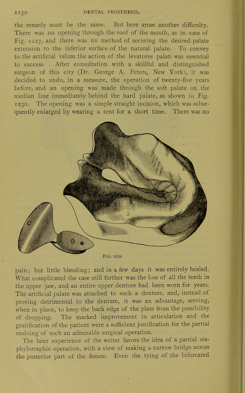 the remedy must be the same. But here arose another difficulty. There was no opening through the roof of the mouth, as in case of Fig. 1227, and there was no method of securing the desired palate extension to the inferior surface of the natural palate. To convey to the artificial velum the action of the levatores palati was essential to success. After consultation with a skillful and distinguished surgeon of this city (Dr. George A. Peters, New York), it was decided to undo, in a measure, the operation of twenty-five years before, and an opening was made through the soft palate on the median line immediately behind the hard palate, as shown in Fig. 1230. The opening was a simple straight incision, which was subse- quently enlarged by wearing a tent for a short time. There was no Fig. 1230. pain; but little bleeding; and in a few days it was entirely healed. What complicated the case still further was the loss of all the teeth in the upper jaw, and an entire upper denture had been worn for years. The artificial palate was attached to such a denture, and, instead of proving detrimental to the denture, it was an advantage, serving, when in place, to keep the back edge of the plate from the possibility of dropping. The marked improvement in articulation and the gratification of the patient were a sufficient justification for the partial undoing of such an admirable surgical operation. The later experience of the writer favors the idea of a partial sta- phylorraphic operation, with a view of making a narrow bridge across the posterior part of the fissure. Even the tying of the bifurcated