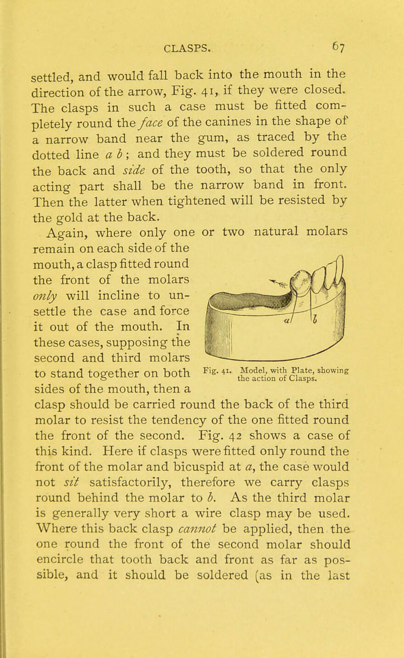 settled, and would fall back into the mouth in the direction of the arrow, Fig. 41, if they were closed. The clasps in such a case must be fitted com- pletely round the face of the canines in the shape of a narrow band near the gum, as traced by the dotted line a h; and they must be soldered round the back and side of the tooth, so that the only acting part shall be the narrow band in front. Then the latter when tightened will be resisted by the gold at the back. Again, where only one or two natural molars remain on each side of the mouth, a clasp fitted round the front of the molars only will incline to un- settle the case and force it out of the mouth. In these cases, supposing the second and third molars to stand together on both sides of the mouth, then a clasp should be carried round the back of the third molar to resist the tendency of the one fitted round the front of the second. Fig. 42 shows a case of this kind. Here if clasps were fitted only round the front of the molar and bicuspid at a, the case would not sit satisfactorily, therefore we carry clasps round behind the molar to b. As the third molar is generally very short a wire clasp may be used. Where this back clasp cannot be applied, then the one round the front of the second molar should encircle that tooth back and front as far as pos- sible, and it should be soldered (as in the last Fig. 41. Model, with Plate, showing the action of Clasps.