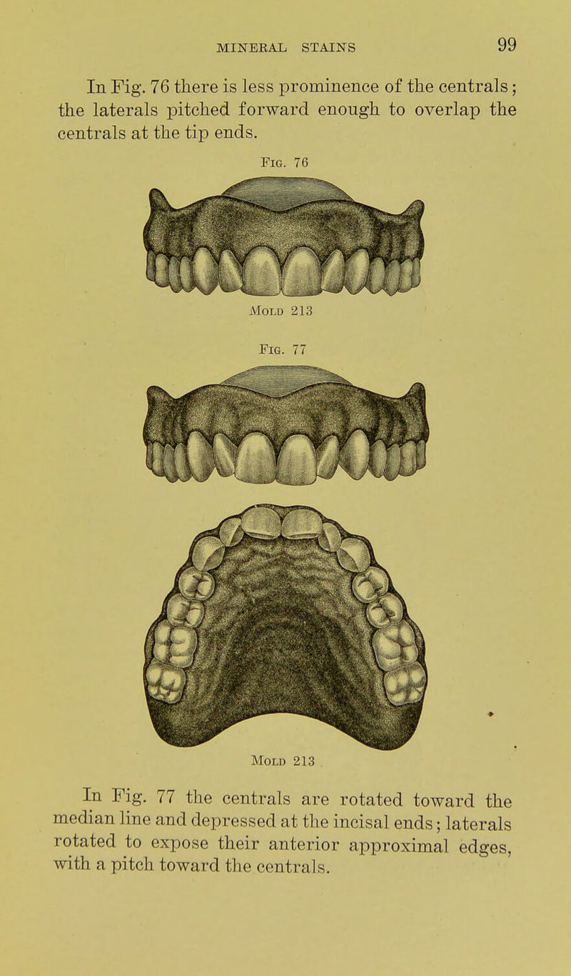 In Fig. 76 there is less prominence of the centrals; the laterals pitched forward enough to overlap the centrals at the tip ends. Fig. 76 Mold 213 In Fig. 77 the centrals are rotated toward the median line and depressed at the incisal ends; laterals rotated to expose their anterior approximal edges, with a pitch toward the centrals.