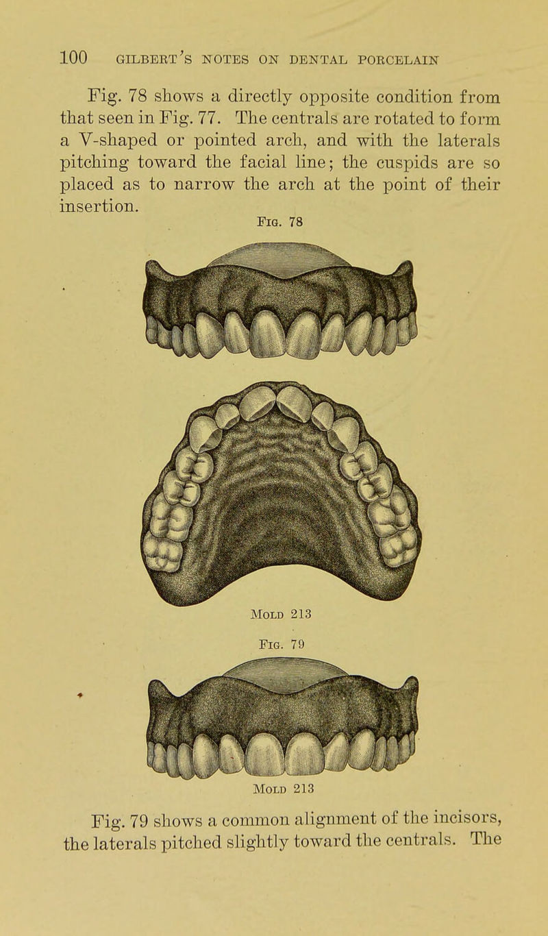 Fig. 78 shows a directly opposite condition from that seen in Fig. 77. The centrals are rotated to form a V-shaped or pointed arch, and with the laterals pitching toward the facial line; the cuspids are so placed as to narrow the arch at the point of their insertion. Fig. 78 Mold 213 Fig. 79 Mold 213 Fig. 79 shows a common alignment of the incisors, the laterals pitched slightly toward the centrals. The