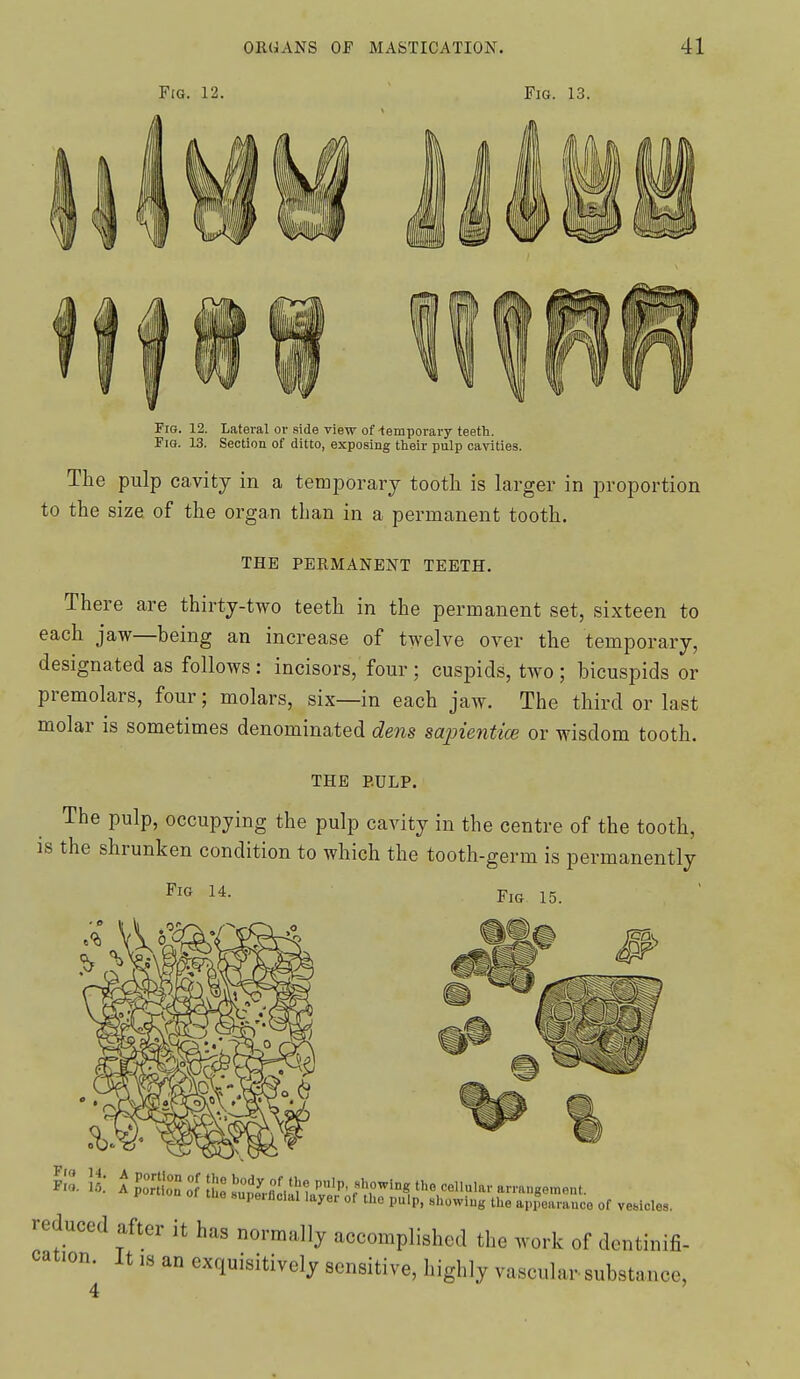 Fig. 12. ' Fig. 13. Pig. 12. Lateral ov side view of-temporary teeth. Fio. 13. Section of ditto, exposing their pnlp cavities. The pulp cavity in a temporarj tooth is larger in proportion in a permanent tooth. to the size of the organ than THE PERMANENT TEETH. There are thirty-two teeth in the permanent set, sixteen to each jaw—being an increase of twelve over the temporary, designated as follows: incisors, four; cuspids, two ; bicuspids or premolars, four; molars, six—in each jaw. The third or last molar is sometimes denominated dens sapientice or wisdom tooth. THE P.ULP. The pulp, occupying the pulp cavity in the centre of the tooth, is the shrunken condition to which the tooth-germ is permanently Fig 14. Fig 15. \t: A IZiZ :\ «X'e';-flciina';er'';.;';rthe ceimiar arrangement. lue supe.flclal layer of the pulp, showing the appearance of vebicles. reduced after it has normally accomplished the work of dentinifi- cation^ It IS an exquisitively sensitive, highly vascular substance.