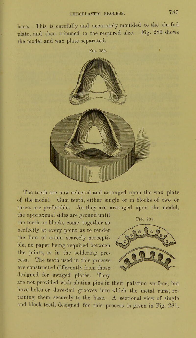 base. This is carefully and accurately moulded to the tin-foil plate, and then trimmed to the required size. Fig. 280 shows the model and wax plate separated. Fig. 280. ' Fig. 281. The teeth are now selected and arranged upon the wax plate of the model. Gum teeth, either single or in blocks of two or three, are preferable. As they are arranged upon the model, the approximal sides are ground until the teeth or blocks come together so perfectly at every point as to render the line of union scarcely percepti- ble, no paper being required between the joints, as in the soldering pro- cess. The teeth used in this process are constructed differently from those designed for swaged plates. They are not provided with platina pins in their palatine surface, but have holes or dove-tail grooves into which the metal runs, re- taining them securely to the base. A sectional view of single and block teeth designed for this process is given in Fig. 281,