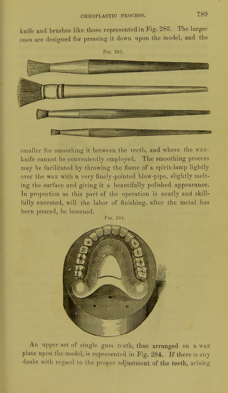 knife and brushes like those represented in Fig. 283. The larger ones are designed for pressing it down upon the model, and the Fig. 283. f^maller for smoothing it between the teeth, and where the wax- knife cannot be conveniently employed. The smoothirig process may be facilitated by throwing the flame of a spirit-lamp lightly over the wax with u very finely-pointed blow-pipe, slightly melt- ing the surface and giving it a beautifully polished appearance. In proportion as this part of the operation is neatly and skill- fully executed, will the labor of finishing, after the metal has been poured, be lessened. Fig. 284. An upper set of single gum t( eth, thus arranged on a wax plate upon the model, is represented in Fig. 284. If there is any doubt with regard to the proper adjustment of the teeth, arising