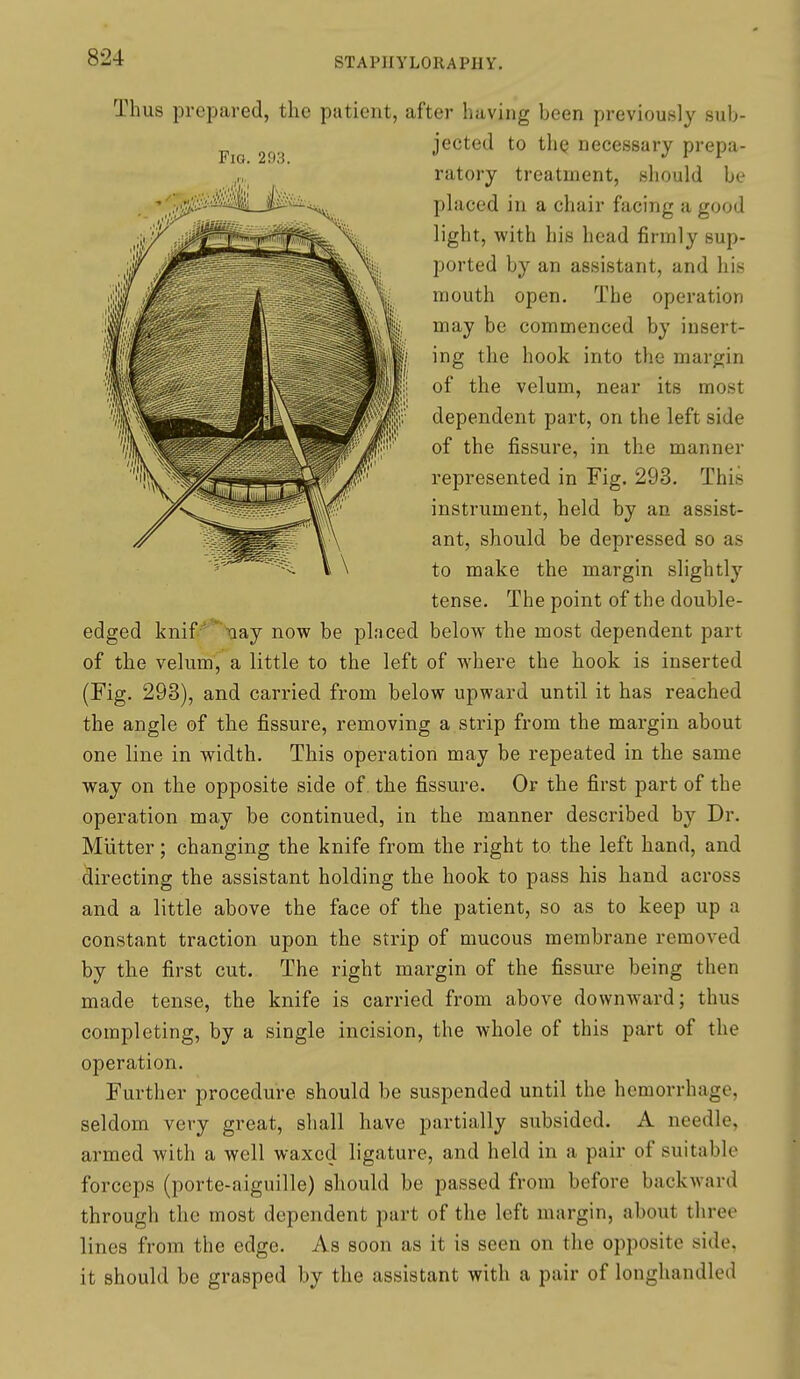 Thus prepared, the patient, after having been previously sub- jected to thQ necessary prepa- ratory treatment, should be placed in a chair facing a good light, with his head firmly sup- ported by an assistant, and his mouth open. The operation may be commenced by insert- ing the hook into the margin of the velum, near its most dependent part, on the left side of the fissure, in the manner represented in Fig. 293. This instrument, held by an assist- ant, should be depressed so as to make the margin slightly tense. The point of the double- edged knif-^'*'-aay now be placed below the most dependent part of the velum, a little to the left of where the hook is inserted (Fig. 293), and carried from below upward until it has reached the angle of the fissure, removing a strip from the margin about one line in width. This operation may be repeated in the same way on the opposite side of. the fissure. Or the first part of the operation may be continued, in the manner described by Dr. Miitter; changing the knife from the right to the left hand, and directing the assistant holding the hook to pass his hand across and a little above the face of the patient, so as to keep up a constant traction upon the strip of mucous membrane removed by the first cut. The right margin of the fissui-e being then made tense, the knife is carried from above downward; thus completing, by a single incision, the whole of this part of the operation. Further procedure should be suspended until the hemorrhage, seldom very great, shall have partially subsided. A needle, armed with a well waxed ligature, and held in a pair of suitable forceps (porte-aiguille) should be passed from before backward through the most dependent part of the left margin, about three lines from the edge. As soon as it is seen on the opposite side, it should be grasped by the assistant with a pair of longhandled