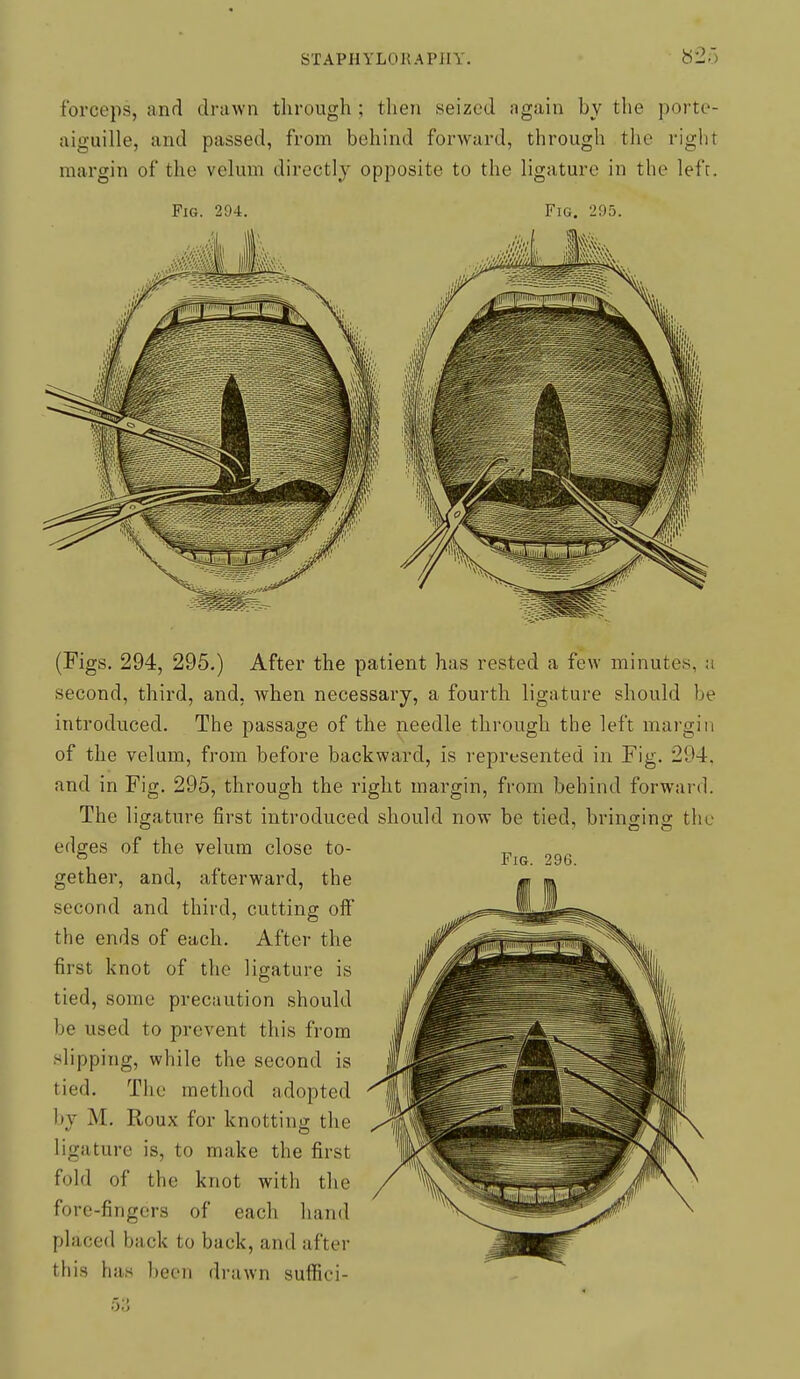 forceps, and drawn through ; then seized again by the porte- aiguille, and passed, from behind forward, through the riglit margin of the velum directly opposite to the ligature in the left. Fig. 294. Fig. 295. Fig. 296. (Figs. 294, 295.) After the patient has rested a few minutes, a second, third, and, when necessary, a fourth ligature should be introduced. The passage of the needle through the left margin of the velum, from before backward, is represented in Fig. 294. and in Fig. 295, through the right margin, from behind forward. The ligature first introduced should now be tied, bringing the edges of the velum close to- gether, and, afterward, the second and third, cutting off the ends of each. After the first knot of the ligature is tied, some precaution should be used to prevent this from slipping, while the second is tied. The method adopted hy M. Roux for knottino; the ligature is, to make the first fold of the knot with the fore-fingers of each hand placed back to back, and after thi.s has been drawn suffici-