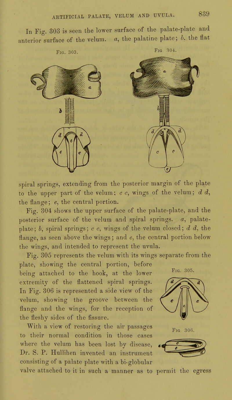 In Fig. 303 is seen the lower surface of the palate-plate and anterior surface of the velum, a, the palatine plate; b. the flat Fig. 303. Fig 304. Fig. 305. spiral springs, extending from the posterior margin of the plate to the upper part of the velum; c c, wings of the velum; d d, the flange; e, the central portion. Fig. 804 shows the upper surface of the palate-plate, and the posterior surface of the velum and spiral springs, a, palate- plate; b, spiral springs; c c, wings of the velum closed; d d, the flange, as seen above the wings; and e, the central portion below the wings, and intended to represent the uvula. Fig. 305 represents the velum with its wings separate from the plate, showing the central portion, before being attached to the hook, at the lower extremity of the flattened spiral springs. In Fig. 306 is represented a side view of the velum, showing the groove between the flange and the wings, for the reception of the fleshy sides of the fissure. With a view of restoring the air passages to their normal condition in those cases where the velum has been lost by disease, Dr. S. P. Ilullihen invented an instrument consisting of a palate plate with a bi-globular valve attached to it in such a manner as to permit the egress Fig 306.