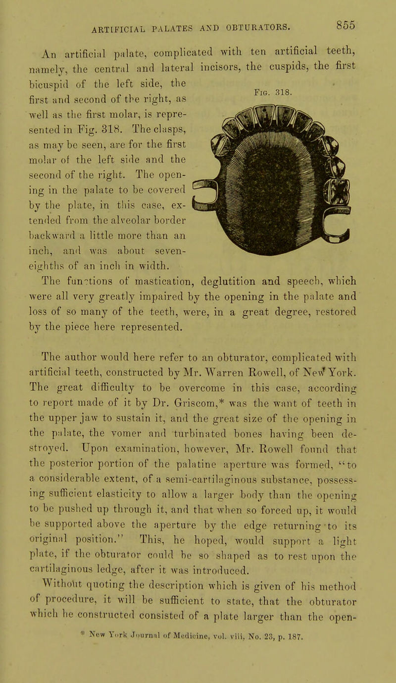 An artificial palate, complicated with ten artificial teeth, namely, the central and lateral incisors, the cuspids, the first bicuspid of the left side, the first and second of the right, as well as the first molar, is repre- sented in Fig. 318. The clasps, as may be seen, are for the first molar of the left side and the second of the right. The open- ing in the palate to be covered by the plate, in this case, ex- tended from the alveolar border backward a little more than an inch, and was about seven- eighths of an incli in width. The fun'?tions of mastication, deglutition and speech, which Avere all very greatly impaired by the opening in the palate and loss of so many of the teeth, were, in a great degree, restored by the piece here represented. The author would here refer to an obturator, complicated with artificial teeth, constructed by Mr. Warren Rowell, of Ne\\* York. The great difiiculty to be overcome in this case, according to report made of it by Dr. Griscom,* was the want of teeth in the upper jaw to sustain it, and the great size of the opening in the palate, the vomer and turbinated bones having been de- stroyed. Upon examination, however, Mr. Rowell found that the posterior portion of the palatine aperture was formed, to a considerable extent, of a aemi-cartilaginous substance, possess- ing sufficient elasticity to allow a larger body than the opening to be pushed up through it, and that when so forced up, it would be supported above the aperture by tlie edge returning-to its original position. This, he hoped, would support a light plate, if the obturator could be so shaped as to rest upon the cartilaginous ledge, after it was introduced. Witho\it quoting the description which is given of his method of procedure, it will be sufiicient to state, that the obturator which he constructed consisted of a plate larger than the open- « Now Ycrk .Jdurnnl of Medujine, vol. viii, No. 23, p. 187.