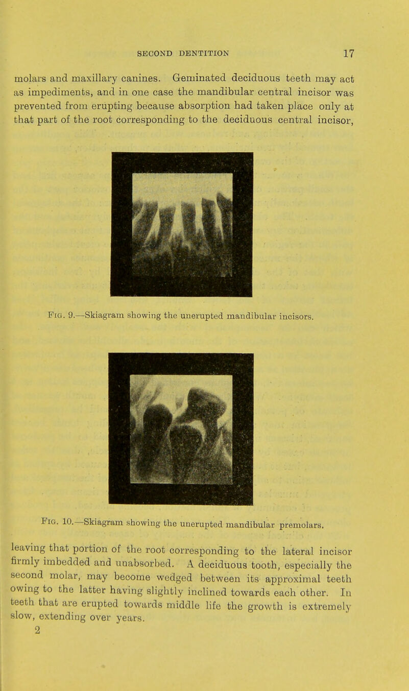 molars and maxillary canines. Geminated deciduous teeth may act as impediments, and in one case the mandibular central incisor was prevented from erupting because absorption had taken place only at that part of the root corresponding to the deciduous central incisor, Fig. 9.—Skiagram showing the unerupted mandibular incisors. Pig. 10.—Skiagram showing the unerupted mandibular premolars. leaving that portion of the root corresponding to the lateral incisor firmly imbedded and unabsorbed. A deciduous tooth, especially the second molar, may become wedged between its approximal teeth owing to the latter having slightly inchned towards each other. la teeth that are erupted towards middle life the growth is extremely slow, extendiug over years. 2