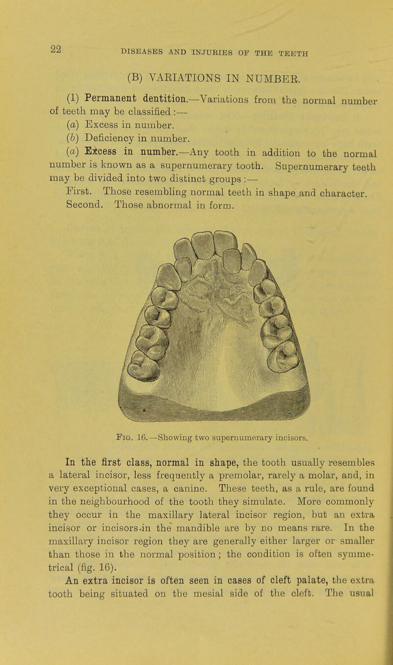 (B) VARIATIONS IN NUMBER. (1) Permanent dentition.—Variations from the normal number of teeth may be classified :— (a) Excess in number. (b) Deficiency in number. (a) Excess in number.—Any tooth in addition to the normal number is known as a supernumerary tooth. Supernumerary teeth may be divided into two distinct groups :— First. Those resembling normal teeth in shape and character. Second. Those abnormal in form. Pig. 16.—Showing two supernumerary incisors, In the first class, normal in shape, the tooth usually resembles a lateral incisor, less frequently a premolar, rarely a molar, and, in very exceptional cases, a canine. These teeth, as a rule, are found in the neighbourhood of the tooth they simulate. More commonly they occur in the maxillary lateral incisor region, but an extra incisor or incisors.in the mandible are by no means rare. In the maxillary incisor region they are generally either larger or smaller than those in the normal position; the condition is often symme- trical (fig. 16). An extra incisor is often seen in cases of cleft palate, tlie extra tooth being situated on the mesial side of the cleft. The usual