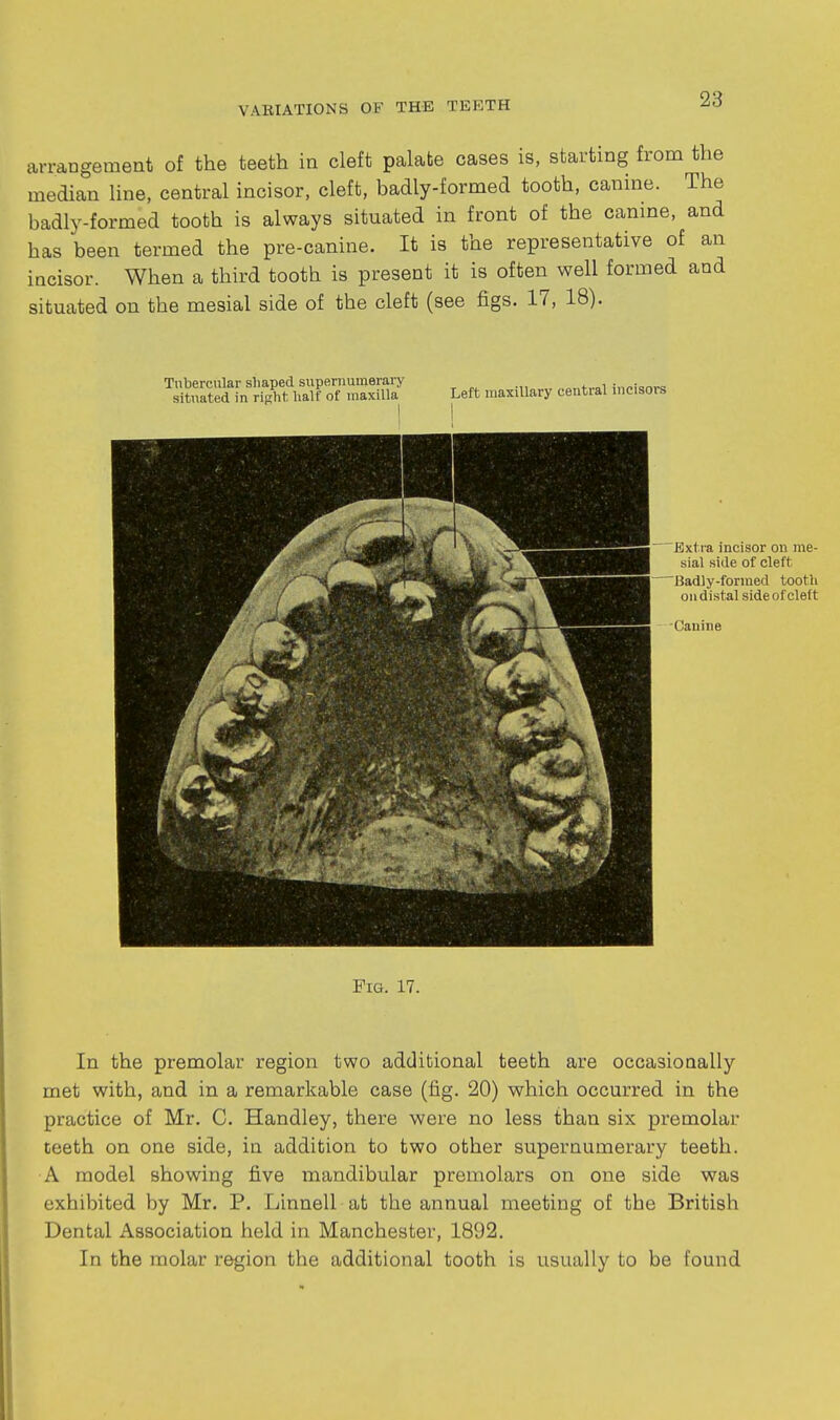arraogement of the teeth in cleft palate cases is, starting from the median line, central incisor, cleft, badly-formed tooth, canine. The badly-formed tooth is always situated in front of the canme, and has been termed the pre-canine. It is the representative of an incisor. When a third tooth is present it is often well formed and situated on the mesial side of the cleft (see figs. 17, 18). In the premolar region two additional teeth are occasionally met with, and in a remarkable case (fig. 20) which occurred in the practice of Mr. C. Handley, there were no less than six premolar teeth on one side, in addition to two other supernumerary teeth. A model showing five mandibular premolars on one side was exhibited by Mr. P. Linnell at the annual meeting of the British Dental Association held in Manchester, 1892. In the molar region the additional tooth is usually to be found