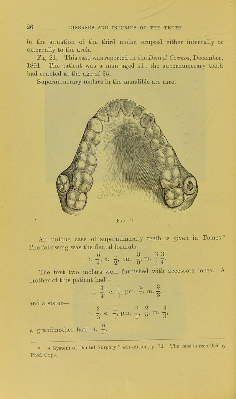 in the situation of the third molar, erupted either internally or externally to the arch. Fig. 21. This case was reported in theDeiital Cosmos, December, 1891. The patient was a man aged 41; the supernumerary teeth had erupted at the age of 35. Supernumerary molars in the mandible are rare. Fig. 21. An unique case of supernumerary teeth is given in Tomes.''' The following was the dental formula :— 5 1 3 3 3 1. c. pm. m. - -. The first two molars were furnished with accessory lobes. A brother of this patient had— 4 1 2 3 ]. -, c. J, pm. -, m. and a sister— .3 1 2 2 3 1. -,e. -,pm. ^, 2'^'^- 3' g a grandmother had—i. —. 2  A System of Dental Surgery, 4tli edition, p. 72. The case is recorded by Prof. Cope.