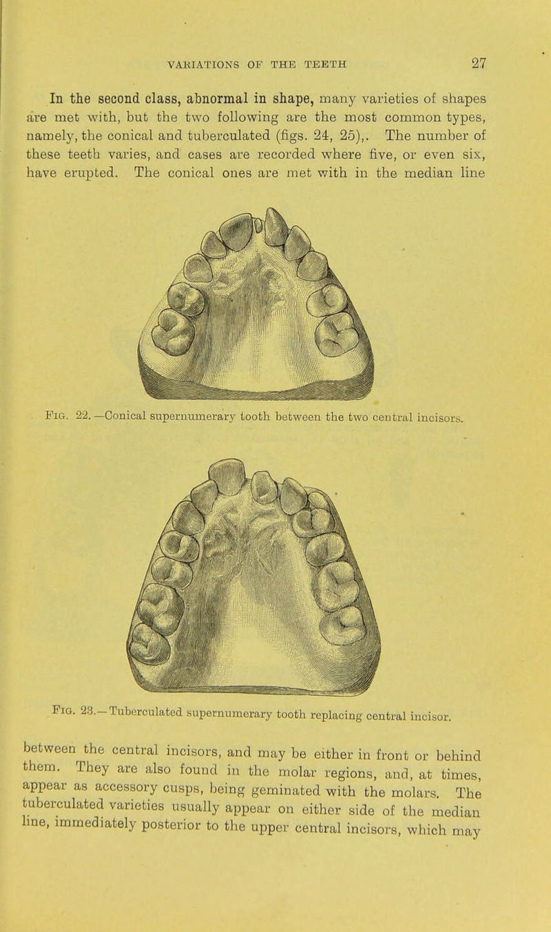 In the second class, abnormal in shape, many varieties of shapes are met with, but the two following are the most common types, namely, the conical and tuberculated (figs. 24, 25),. The number of these teeth varies, and cases are recorded where five, or even six, have erupted. The conical ones are met with in the median line Fig. 22.—Conical supernumerary tooth between the two central incisors. Pig. 23.—Tuberculated supernumerary tooth replacing central mcisor. between the central incisors, and may be either in front or behind them. They are also found in the molar regions, and, at times, appear as accessory cusps, being geminated with the molars. The tuberculated varieties usually appear on either side of the median hne, immediately posterior to the upper central incisors, which may