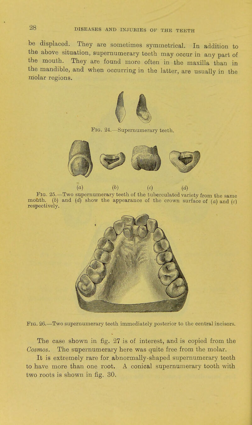 be displaced. They are sometimes symmetrical. In addition to the above situation, supernumerary teeth may occur in any part of the mouth. They are found more often in the maxilla than in the mandible, and when occurring in the latter, are usually in the rdolar regions. Fig. 24.—Supernumerary teeth. (a) (b) (c) (d) Fig. 25.—Two supernumerary teeth of the tuberculated variety from the same mouth, (b) and (d) show the appearance of the crown surface of (a) and (c) respectively. Fig. 26.—Two supernumerary teeth immediately posterior to the central incisors. The case shown in fig. 27 is of interest, and is copied from the Cosmos. The supernumerary here was quite free from the molar. It is extremely rare for abnormally-shaped supernumerary teeth to have more than one root. A conical supernumerary tooth with two roots is shown in fi.g. 30.