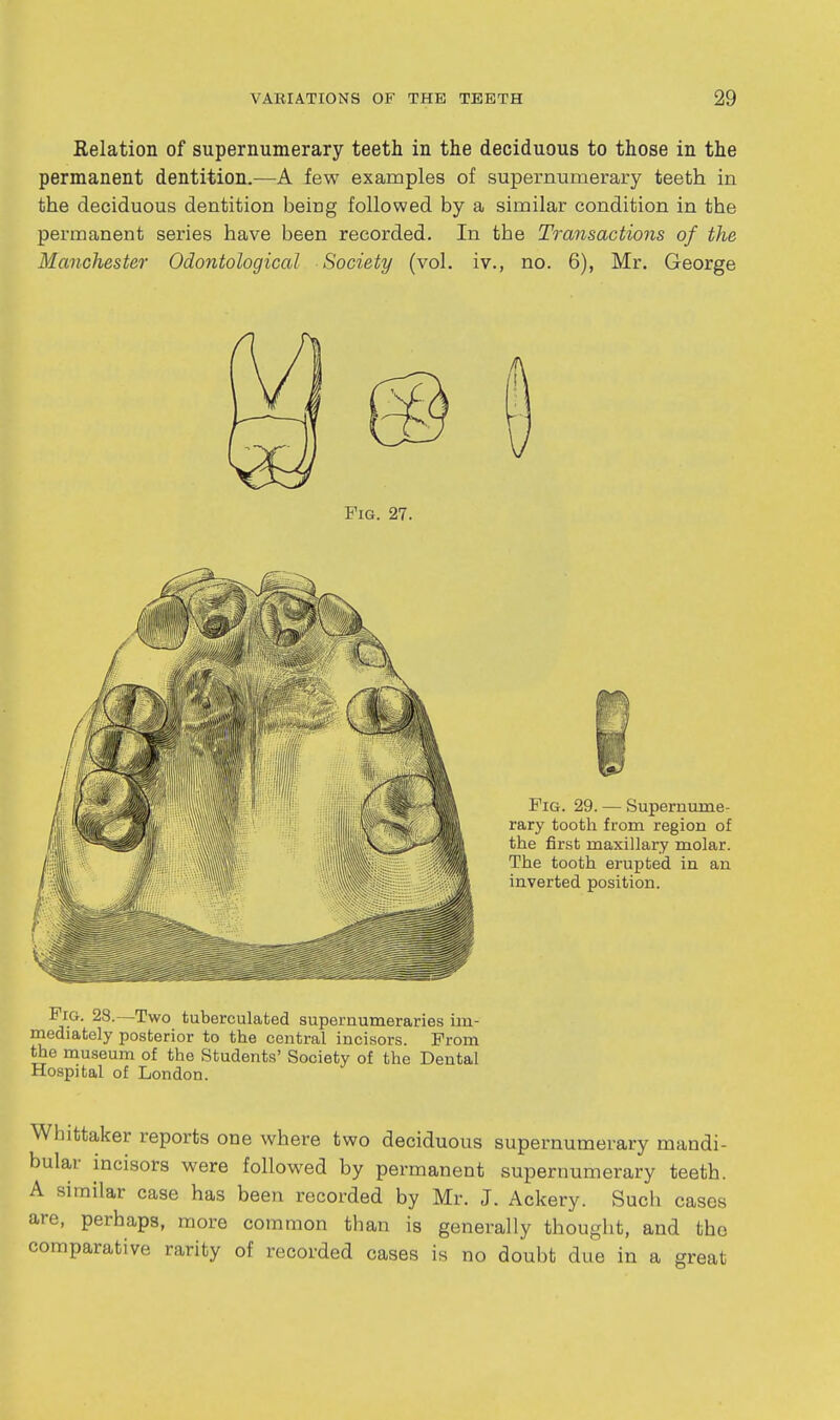 Relation of supernumerary teeth in the deciduous to those in the permanent dentition.—A few examples of supernumerary teeth in the deciduous dentition being followed by a similar condition in the permanent series have been recorded. In the Transactions of the Manchester Odontological Society (vol. iv., no. 6), Mr. George Fig. 27. Pig. 28.—Two tuberculated supernumeraries im- mediately posterior to the central incisors. From the museum of the Students' Society of the Dental Hospital of London. Whittaker reports one where two deciduous supernumerary mandi- bular incisors were followed by permanent supernumerary teeth. A similar case has been recorded by Mr. J. Ackery. Such cases are, perhaps, more common than is generally thought, and the comparative rarity of recorded cases is no doubt due in a great