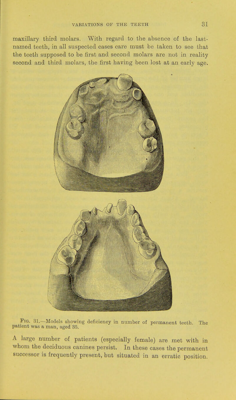 maxillary third molars. With regard to the absence of the last- named teeth, in all suspected cases care must be taken to see that the teeth supposed to be first and second molars are not in reality second and third molars, the first having been lost at an early age. Fig. 31.—Models showing deficiency in number of permanent teeth. The patient was a man, aged 35. A large number of patients (especially female) are met with in whom the deciduous canines persist. In these cases the permanent successor is frequently present, but situated in an erratic position.