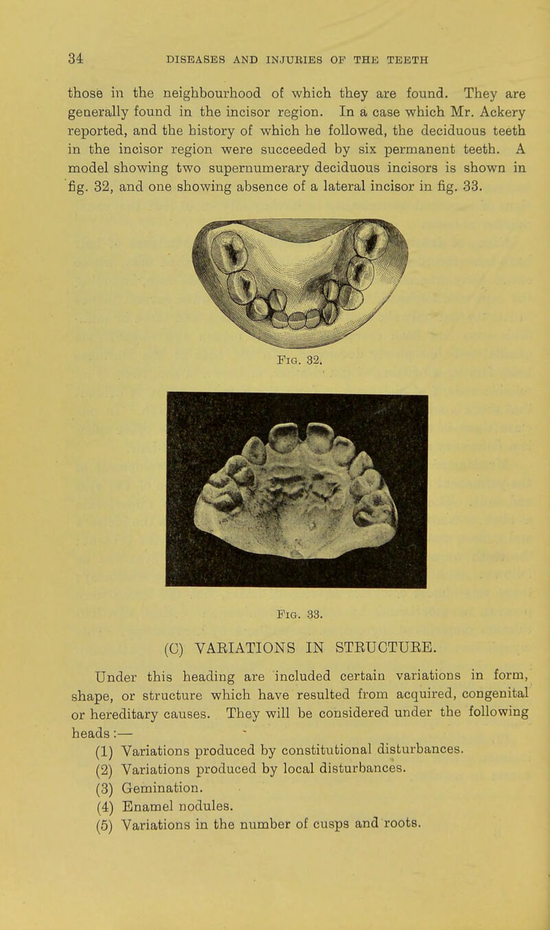 thosia in the neighbourhood ot which they are found. They are generally found in the incisor region. In a case which Mr. Ackery reported, and the history of which he followed, the deciduous teeth in the incisor region were succeeded by six permanent teeth. A model showing two supernumerary deciduous incisors is shown in fig. 32, and one showing absence of a lateral incisor in fig. 33. Fig. .33. (G) VAEIATIONS IN STEUCTUEE. Under this heading are included certain variations in form, shape, or structure which have resulted from acquired, congenital or hereditary causes. They will be considered under the following heads:— (1) Variations produced by constitutional disturbances. (2) Variations produced by local disturbances. (3) Gemination. (4) Enamel nodules. (6) Variations in the number of cusps and roots.