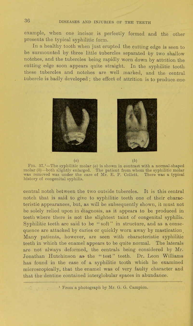example, when one incisor is perfectly formed and the other presents the typical syphilitic form. In a healthy tooth when just erupted the cutting edge is seen to be surmounted by three little tubercles separated by two shallow notches, and the tubercles being rapidly worn down by attrition the cutting edge soon appears quite straight. In the syphilitic tooth these tubercles and notches are well marked, and the central tubercle is badly developed ; the effect of attrition is to produce one (a) (b) Fig. 37.'—The syphilitic molar (a) is shown in contrast with a normal-shaped molar {b)—both slightly enlarged. The patient from whom the syphilitic molar was removed was under the care of Mr. E. P. Collett. There was a typical history of congenital syphilis. central notch between the two outside tubercles. It is this central notch that is said to give to syphilitic teeth one of their charac- teristic appearances, but, as will be subsequently shown, it must not be solely relied upon in diagnosis, as it appears to be produced in teeth where there is not the slightest taint of congenital syphilis. Syphilitic teeth are said to be  soft  in structure, and as a conse- quence are attacked by caries or quickly worn away by mastication. Many patients, however, are seen with characteristic syphilitic teeth in which the enamel appears to be quite normal. The laterals ai'e not always deformed, the centrals being considered by Mr. Jonathan Hutchinson as- the  test teeth. Dr. Leon Wilhams has found in the case of a syphilitic tooth which he examined microscopically, that the enamel was of very faulty character and that the dentine contained interglobular spaces in abundance.
