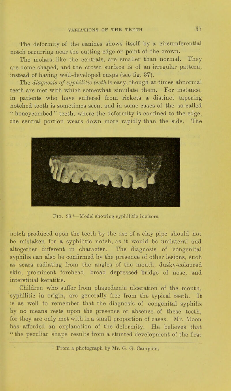 The deformity of the canines shows itself by a circumferential notch occurring near the cutting edge or point of the crown. The molars, like the centrals, are smaller than normal. They are dome-shaped, and the crown surface is of an irregular pattern, instead of having well-developed cusps (see fig. 37). The diagnosis of syphilitic teethis easy, though at times abnormal teeth are met with which somewhat simulate them. For instance, in patients who have suffered from rickets a distinct tapering notched tooth is sometimes seen, and in some cases of the so-called honeycombed teeth, where the deformity is confined to the edge, the central portion wears down more rapidly than the side. The Fig. 38.'—IModel showing syphilitic incisors. notch produced upon the teeth by the use of a clay pipe should not be mistaken for a syphilitic notch, as it would be unilateral and altogether different in character. The diagnosis of congenital syphilis can also be confirmed by the presence of other lesions, fsuch as scars radiating from the angles of the mouth, dusky-coloured skin, prominent forehead, broad depressed bridge of nose, and interstitial keratitis. Children who suffer from phagedaenic ulceration of the mouth, syphilitic in origin, are generally free from the typical teeth. It is as well to remember that the diagnosis of congenital syphilis by no means rests upon the presence or absence of these teeth, for they are only met with in a small proportion of cases. Mr. Moon has afforded an explanation of the deformity. He believes that the peculiar shape results from a stunted development of the first