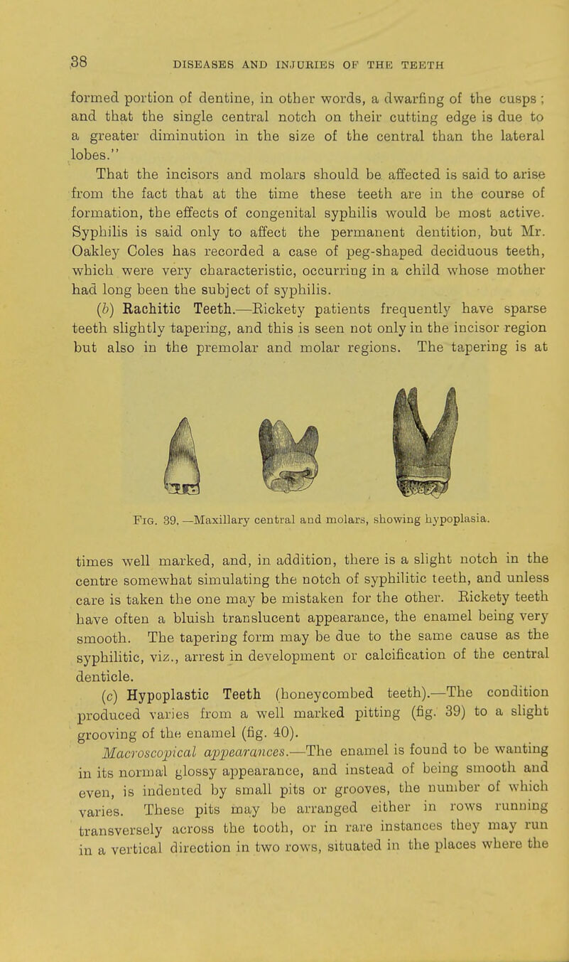 ,88 formed portion of dentine, in other words, a dwarfing of the cusps ; and that the single central notch on their cutting edge is due to a greater diminution in tlie size of the central than the lateral lobes. That the incisors and molars should be. affected is said to arise from the fact that at the time these teeth are in the course of formation, the effects of congenital syphilis would be most active. Syphilis is said only to affect the permanent dentition, but Mr. Oakley Coles has recorded a case of peg-shaped deciduous teeth, which were very characteristic, occurring in a child whose mother had long been the subject of syphilis. (b) Rachitic Teeth.—Eickety patients frequently have sparse teeth slightly tapering, and this is seen not only in the incisor region but also in the premolar and molar regions. The tapering is at Fig. 39. —Maxillary central and molars, showing hypoplasia. times well marked, and, in addition, there is a slight notch in the centre somewhat simulating the notch of syphilitic teeth, and unless care is taken the one may be mistaken for the other. Eickety teeth have often a bluish translucent appearance, the enamel being very smooth. The tapering form may be due to the same cause as the syphiUtic, viz., arrest in development or calcification of the central denticle. (c) Hypoplastic Teeth (honeycombed teeth).—The condition produced varies from a well marked pitting (fig. 39) to a slight grooving of the enamel (fig. 40). Macroscojncal ai^pearances.—The enamel is found to be wanting in its normal glossy appearance, and instead of being smooth and even, is indented by small pits or grooves, the number of which varies. These pits may be arranged either in rows running transversely across the tooth, or in rare instances they may run in a vertical direction in two rows, situated in the places where the