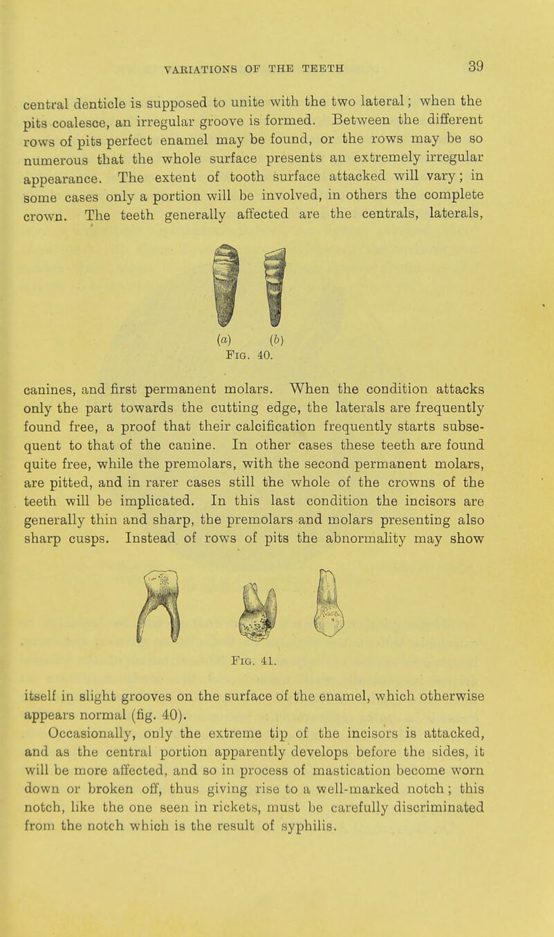 central denticle is supposed to unite with the two lateral; when the pits coalesce, an irregular groove is formed. Between the different rows of pits perfect enamel may be found, or the rows may be so numerous that the whole surface presents an extremely irregular appearance. The extent of tooth surface attacked will vary; in some cases only a portion will be involved, in others the complete crown. The teeth generally affected are the centrals, laterals, (a) (b) Fig. 40. canines, and first permanent molars. When the condition attacks only the part towards the cutting edge, the laterals are frequently found free, a proof that their calcification frequently starts subse- quent to that of the canine. In other cases these teeth are found quite free, while the premolars, with the second permanent molars, are pitted, and in rarer cases still the whole of the crowns of the teeth will be implicated. In this last condition the incisors are generally thin and sharp, the premolars and molars presenting also sharp cusps. Instead of rows of pits the abnormality may show Fig. 41. itself in slight grooves on the surface of the enamel, which otherwise appears normal (fig. 40). Occasionally, only the extreme tip of the incisors is attacked, and as the central portion apparently develops before the sides, it will be more affected, and so in process of mastication become worn down or broken off, thus giving rise to a well-marked notch; this notch, like the one seen in rickets, must be carefully discriminated from the notch which is the result of syphilis.