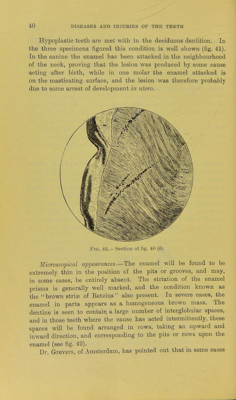 Hypoplastic teeth are met with in the deciduous dentition. In the three specimens figured this condition is well shown (fig. 41). In the canine the enamel has been attacked in the neighbourhood of the neck, proving that the lesion was produced by some cause acting after birth, while in one molar the enamel attacked is on the masticating surface, and the lesion was therefore probably due to some arrest of development in titero. Fig. 42.-Section of fig. 40 {b). Microscopical appearances .—The enamel will be found to be extremely thin in the position of the pits or grooves, and may, in some cases, be entirely absent. The striation of the enamel prisms is generally well marked, and the condition known as the  brown 8tri£e of Eetzius  also present. In severe cases, the enamel in parts appears as a homogeneous brown mass. The dentine is seen to contain a large number of interglobular spaces, and in those teeth where the cause has acted intermittently, these spaces will be found arranged in rows, taking an upward and inward direction, and corresponding to the pits or rows upon the enamel (see fig. 42). Dr. Grevers, of Amsterdam, has pointed out that in some cases