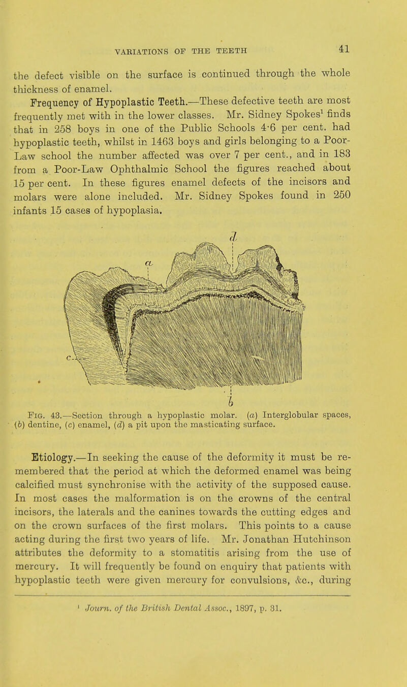 the defect visible on the surface is continued through the whole thickness of enamel. Frequency of Hypoplastic Teeth.—These defective teeth are most frequently met with in the lower classes. Mr, Sidney Spokes^ finds that in 258 boys in one of the Public Schools 4-6 per cent, had hypoplastic teeth, whilst in 1463 boys and girls belonging to a Poor- Law school the number affected was over 7 per cent., and in 183 from a Poor-Law Ophthalmic School the figures reached about 15 per cent. In these figures enamel defects of the incisors and molars were alone included. Mr. Sidney Spokes found in 250 infants 15 cases of hypoplasia. i Fig. 43.—Section through a hypoplastic molar, (a) Interglobular spaces, (b) dentine, (c) enamel, (d) a pit upon the masticating surface. Etiology.—In seeking the cause of the deformity it must be re- membered that the period at which the deformed enamel was being calcified must synchronise with the activity of the supposed cause. In most cases the malformation is on the crowns of the central incisors, the laterals and the canines towards the cutting edges and on the crown surfaces of the first molars. This points to a cause acting during the first two years of life. Mr. Jonathan Hutchinson attributes the deformity to a stomatitis arising from the use of mercury. It will frequently be found on enquiry that patients with hypoplastic teeth were given mercury for convulsions, &c., during Journ. of the British Dental Assoc., 1897, p. 31.