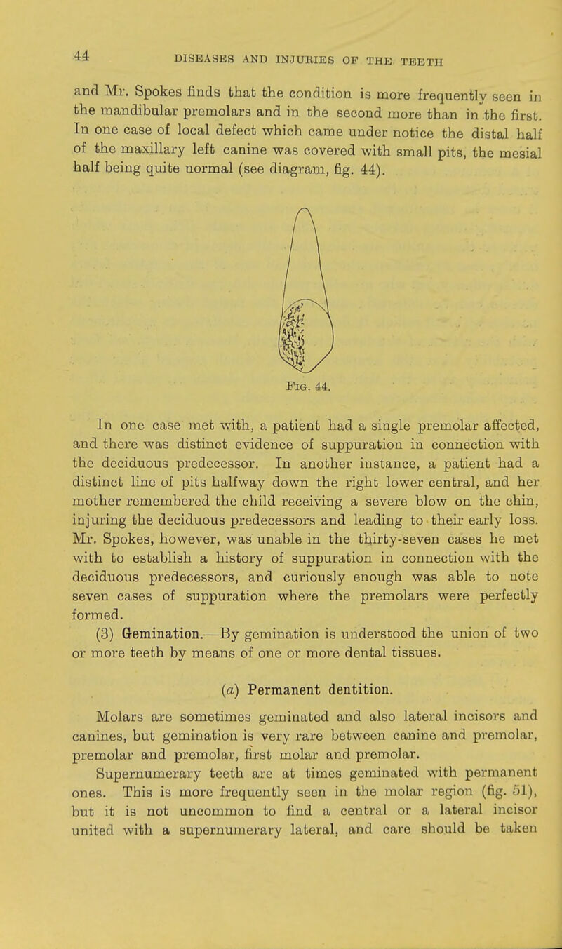 and Mr. Spokes finds that the condition is more frequently seen in the mandibular premolars and in the second more than in the first. In one case of local defect which came under notice the distal half of the maxillary left canine was covered with small pits, the mesial half being quite normal (see diagram, fig. 44). Fig. 44. In one case met with, a patient had a single premolar affected, and there was distinct evidence of suppuration in connection with the deciduous predecessor. In another instance, a patient had a distinct line of pits halfway down the right lower central, and her mother remembered the child receiving a severe blow on the chin, injuring the deciduous predecessors and leading to their early loss. Mr. Spokes, however, was unable in the thirty-seven cases he met with to establish a history of suppuration in connection with the deciduous predecessors, and curiously enough was able to note seven cases of suppuration where the premolars were perfectly formed. (3) Gemination.—By gemination is understood the union of two or more teeth by means of one or more dental tissues. (a) Permanent dentition. Molars are sometimes geminated and also lateral incisors and canines, but gemination is very rare between canine and premolar, premolar and premolar, first molar and premolar. Supernumerary teeth are at times geminated with permanent ones. This is more frequently seen in the molar region (fig. 51), but it is not uncommon to find a central or a lateral incisor united with a supernumerary lateral, and care should be taken
