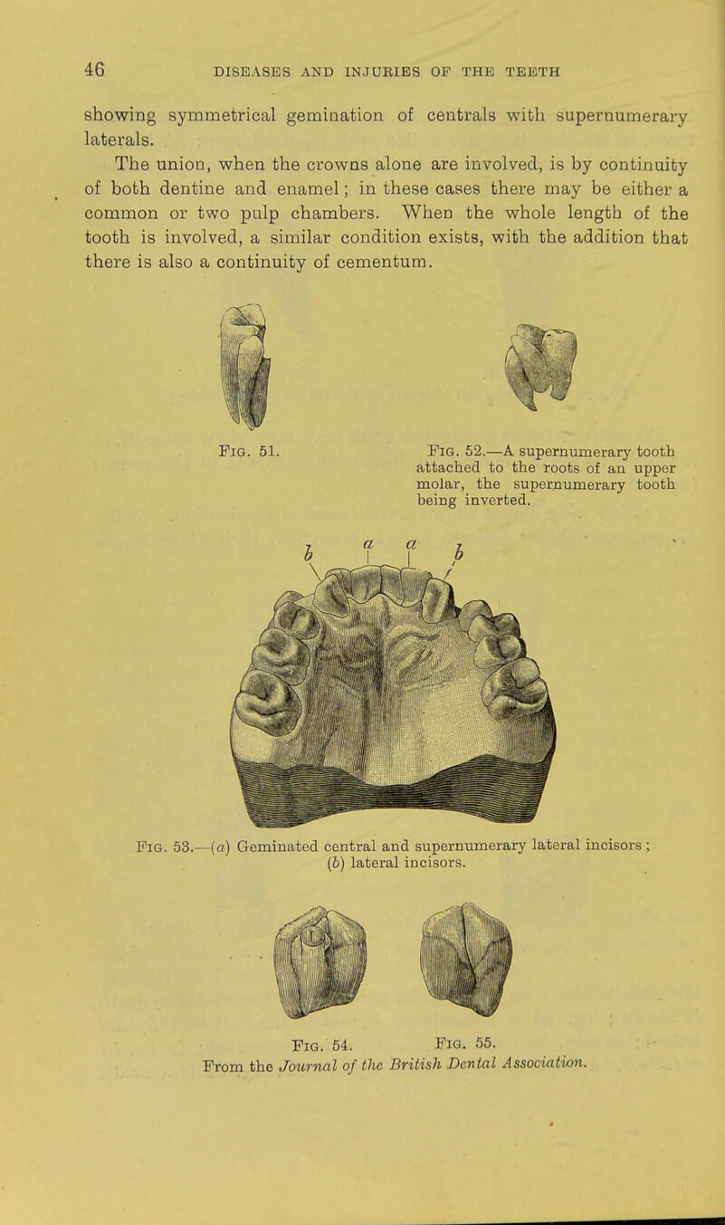 showing symmetrical gemination of centrals with supernumerary laterals. The union, when the crowns alone are involved, is by continuity of both dentine and enamel; in these cases there may be either a common or two pulp chambers. When the whole length of the tooth is involved, a similar condition exists, with the addition that there is also a continuity of cementum. Pig. 51. Pig. 52.—A supernumerary tooth attached to the roots of an upper molar, the supernumerary tooth being inverted. Pig. 53.—(a) Geminated central and supernumerary lateral incisors; (b) lateral incisors. Fig. 54. PiQ. 55. Prom the Journal of the British Dental Associatian.