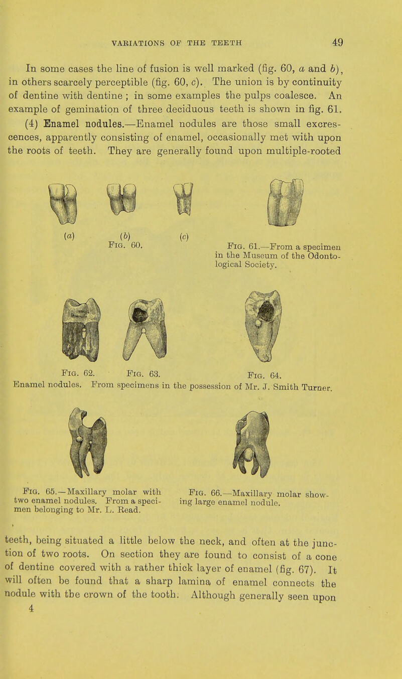 In some cases the line of fusion is well marked (fig. 60, a and 6), in others scarcely perceptible (fig. 60, c). The union is by continuity of dentine with dentine ; in some examples the pulps coalesce. An example of gemination of three deciduous teeth is shown in fig. 61. (4) Enamel nodules.—Enamel nodules are those small excres- cences, apparently consisting of enamel, occasionally met with upon the roots of teeth. They are generally found upon multiple-rooted Fig. 62. Pig. 63. Fig. 64. Enamel nodules. From specimens in the possession of Mr. J. Smith Turner. Fig. 65. —Maxillary molar with Fig. 66.—Maxillary molar show- two enamel nodules. From a speci- ing large enamel nodule, men belonging to Mr. L. Read. teeth, being situated a little below the neck, and often at the junc- tion of two roots. On section they are found to consist of a cone of dentine covered with a rather thick layer of enamel (fig. 67). It will often be found that a sharp lamina of enamel connects the nodule with the crown of the tooth. Although generally seen upon 4