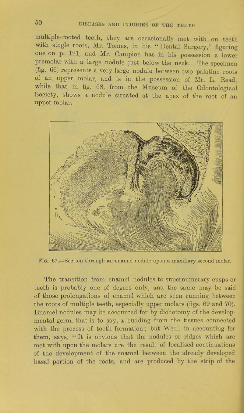 60 inultiple-rooted teeth, they are occasionally met with on teeth with single roots, Mr. Tomes, in his  Dental Surgery, figuring one on p. 121, and Mr. Campion has in his possession a lower premolar with a large nodule just below the neck. The specimen (fig. 66) represents a very large nodule between two palatine roots of an upper molar, and is in the possession of Mr. L. Read, while that in fig. 68, from the Museum of the Odontological Society, shows a nodule situated at the apex of the root of an upper molar. Fig. 67.—Section through an enamel nodule upon a maxillary second molar. The transition from enamel nodules to supernumerary cusps or teeth is probably one of degree only, and the same may be said of those prolongations of enamel which are seen running between the roots of multiple teeth, especially upper molars (figs. 69 and 70). Enamel nodules may be accounted for by dichotomy of the develop- mental germ, that is to say, a budding from the tissues connected with the process of tooth formation ; but Wedl, in accounting for them, says,  It is obvious that the nodules or ridges which are met with upon the molars are the result of localised continuations of the development of the enamel between the already developed basal portion of the roots, and are produced by the strip of the