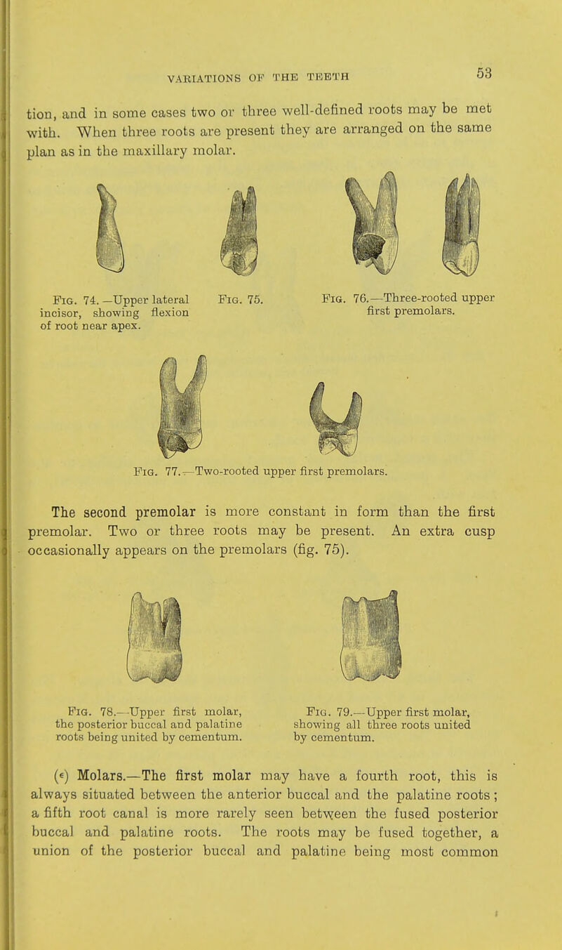 tion, and in some cases two or three well-defined roots may be met with. When three roots are present they are arranged on the same plan as in the maxillary molar. Fig. 74.-Upper lateral Fig. 75. Fig. 76.—Three-rooted upper incisor, showing flexion first premolars, of root near apex. Fig. 77.-^Two-rooted upper first premolars. The second premolar is more constant in form than the first premolar. Two or three roots may be present. An extra cusp occasionally appears on the premolars (fig. 75). Fig. 78.--Upper first molar, Fig. 79.—Upper first molar, the posterior buccal and palatine showing all three roots united roots being united by cementum. by cementum. («) Molars.—The first molar may have a fourth root, this is always situated between the anterior buccal and the palatine roots; a fifth root canal is more rarely seen between the fused posterior buccal and palatine roots. The roots may be fused together, a union of the posterior buccal and palatine being most common