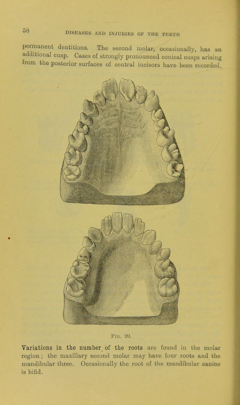 DISEASES AND INJUllIES OF THE TEETH permanent dentitions. The second molar, occasionally, has an additional cusp. Cases of strongly pronounced conical cusps arising from the posterior surfaces of central incisors have been n^corded. Fig. 99. Variations in the number of the roots are found in the molar region ; the maxillary second molar may have four roots and the mandibular three. Occasionally the root of tlie mandibular canine is bifid.